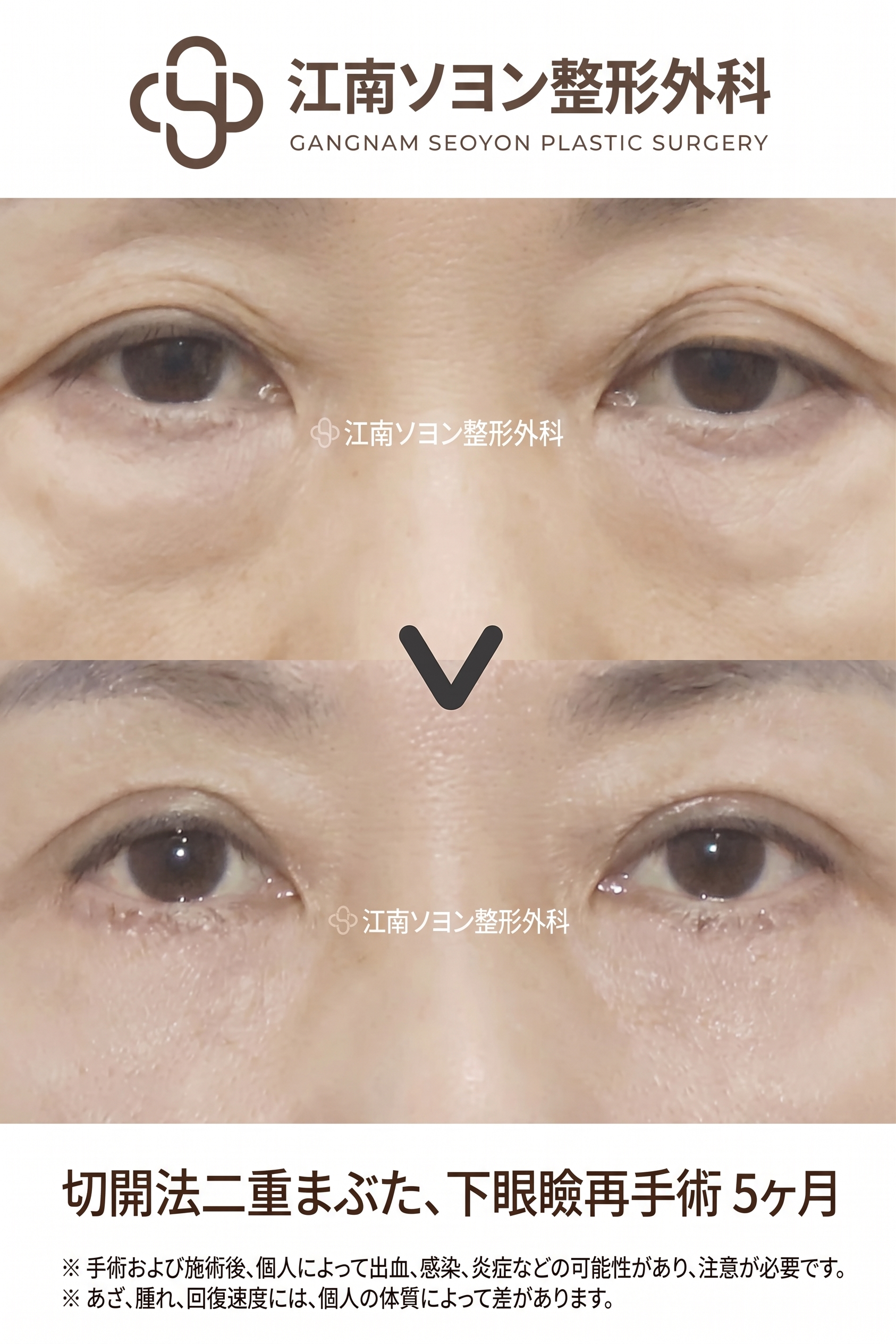下眼瞼手術（目の下のたるみ取り）が適している場合とは？どのような目の下の状態なら検討できる？