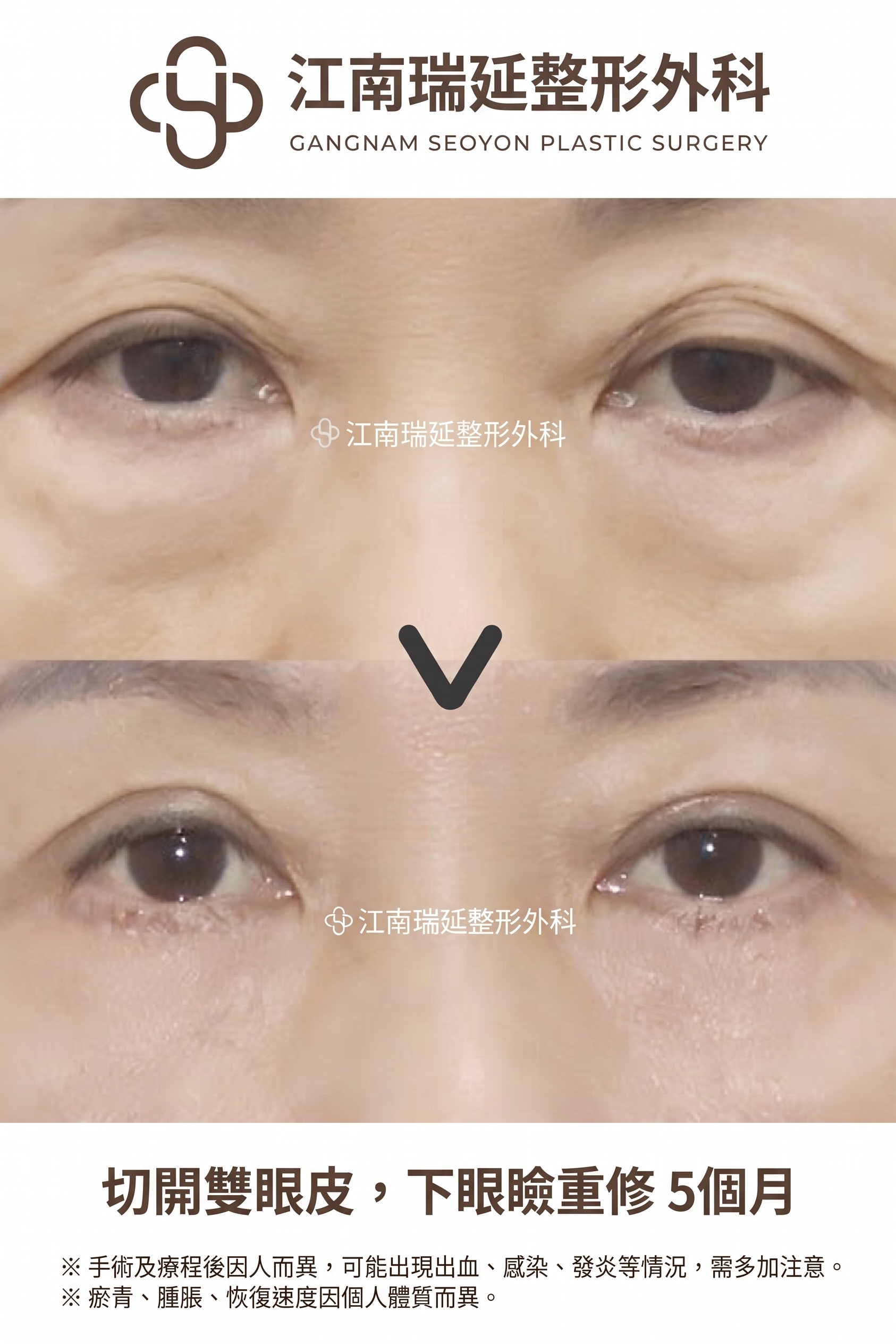 適合下眼瞼手術的情況：在何種眼下狀態下可以考慮？