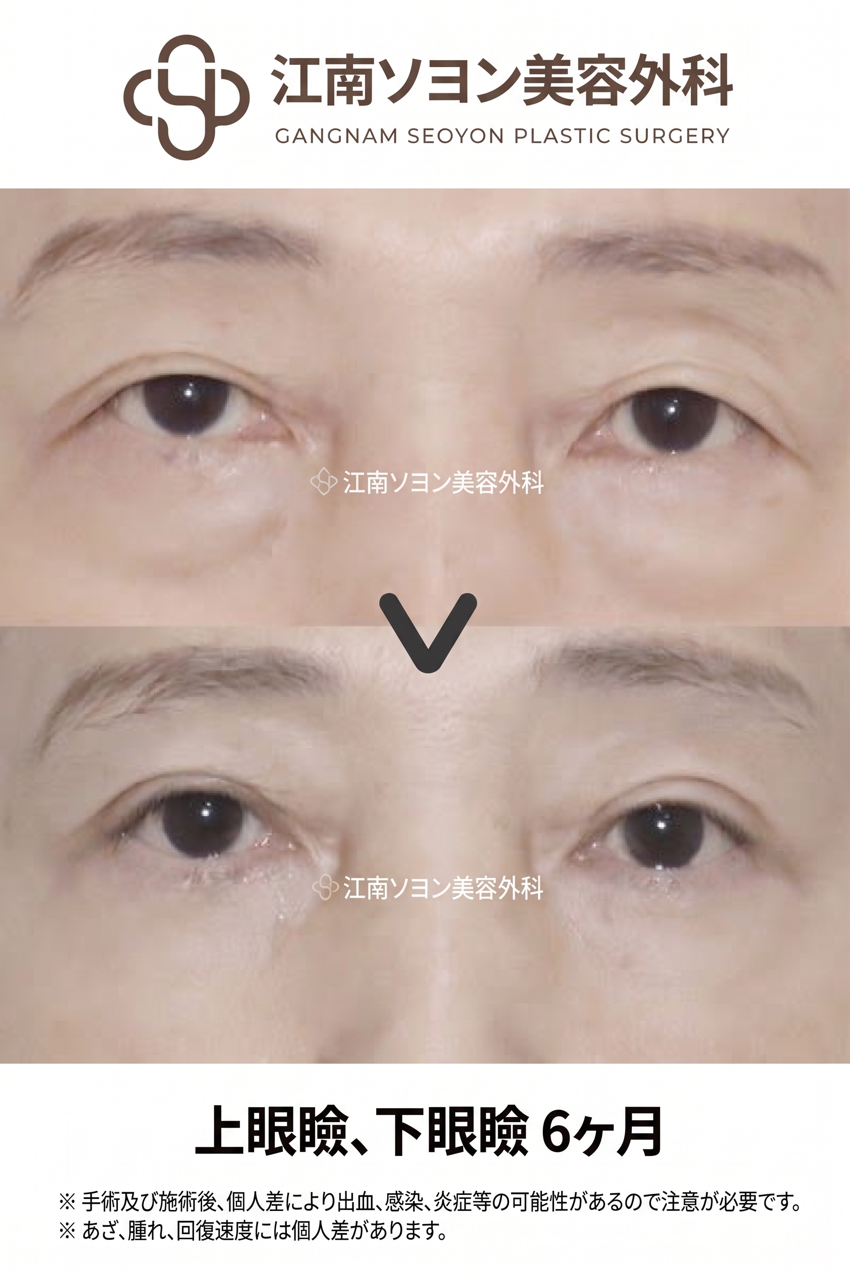 下眼瞼手術（目の下のたるみ取り）が適している場合とは？どのような目の下の状態なら検討できる？ 사진 8