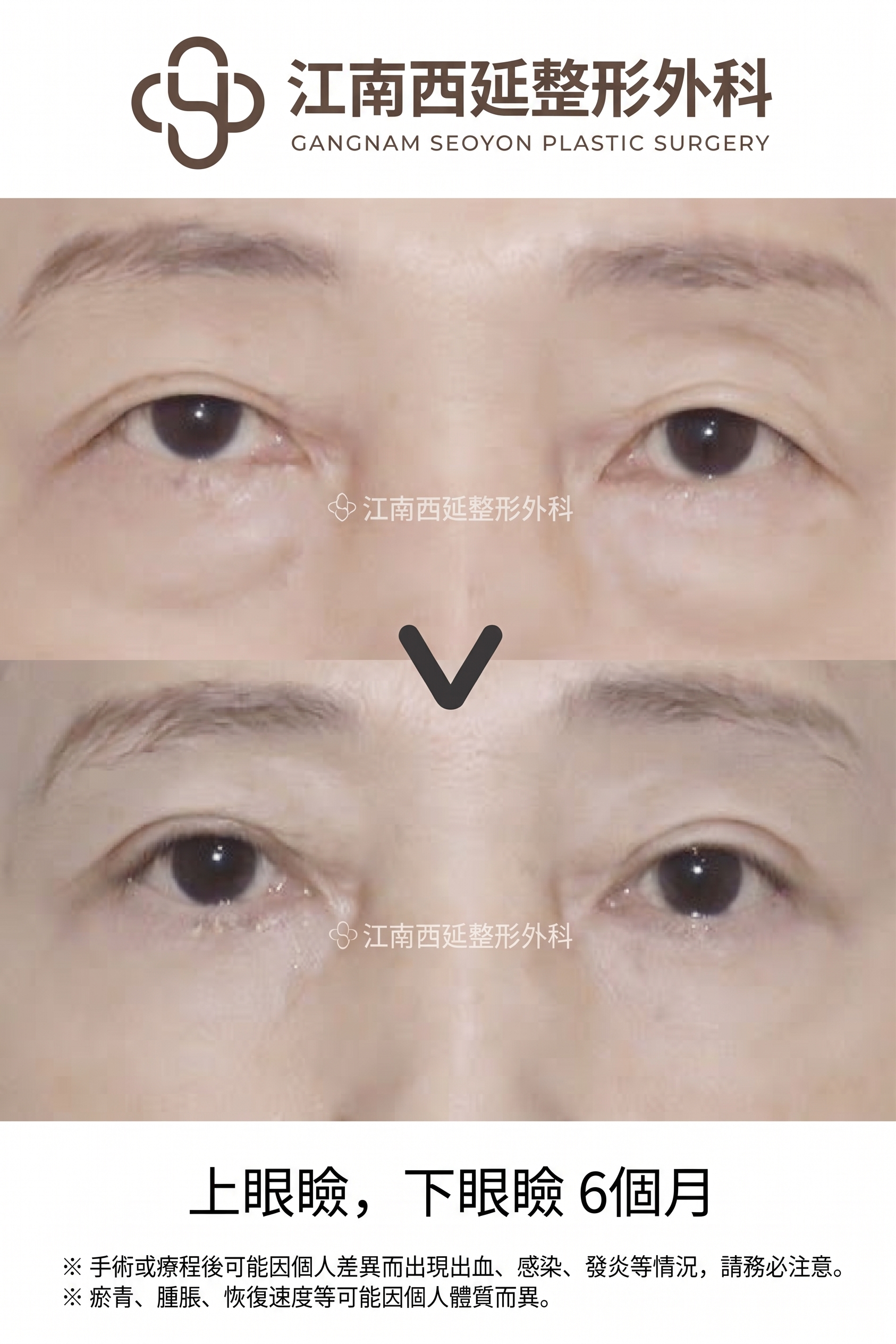 適合下眼瞼手術的情況：在何種眼下狀態下可以考慮？ 사진 8