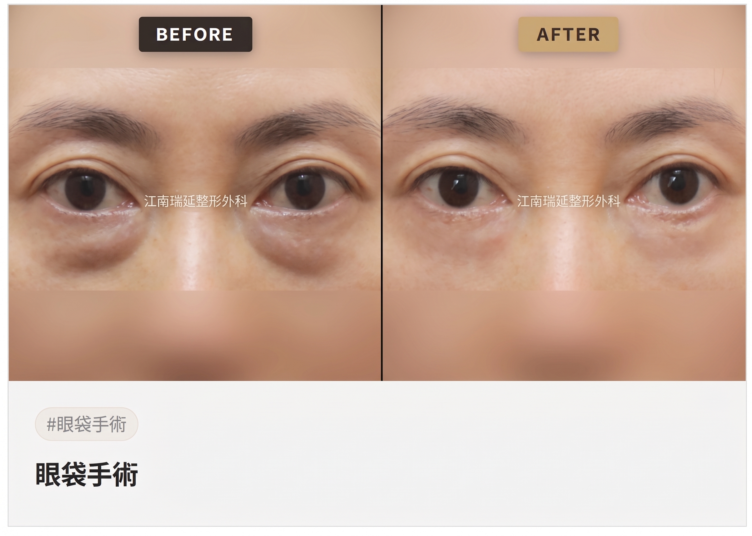 適合下眼瞼手術的情況：在何種眼下狀態下可以考慮？ 사진 4