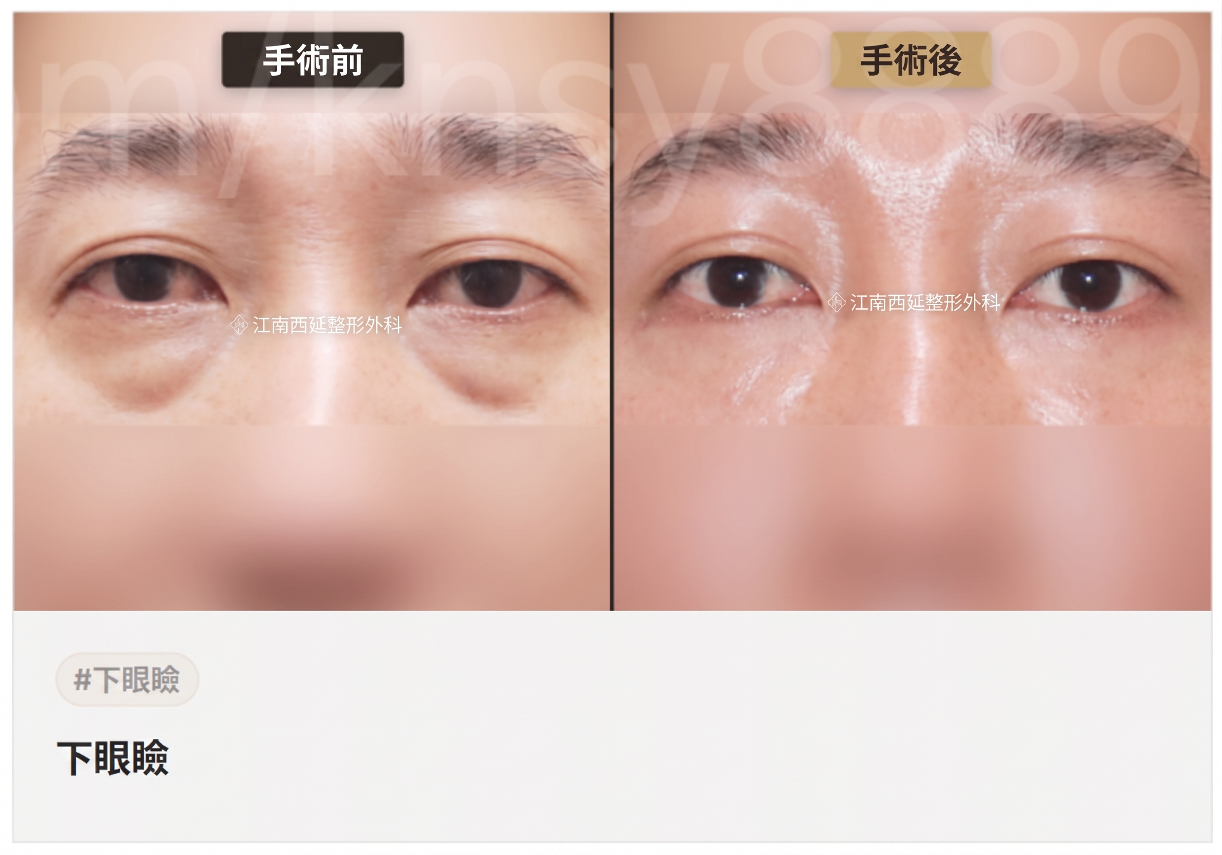 適合下眼瞼手術的情況：在何種眼下狀態下可以考慮？ 사진 5