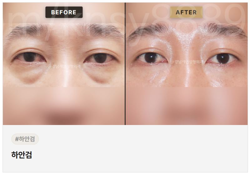 하안검 수술 적합한 경우, 어떤 눈밑 상태에서 고려할 수 있을까요? 사진 5