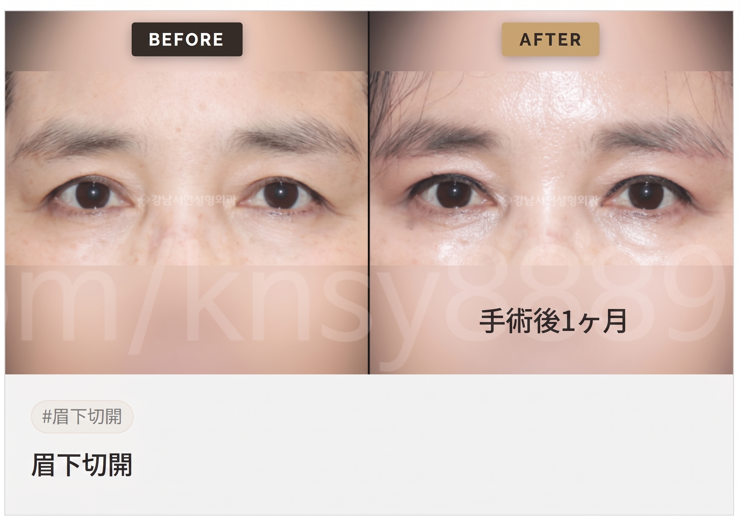 眉下切開（眉下リフト）が適しているケース、自分は当てはまる？ 사진 3