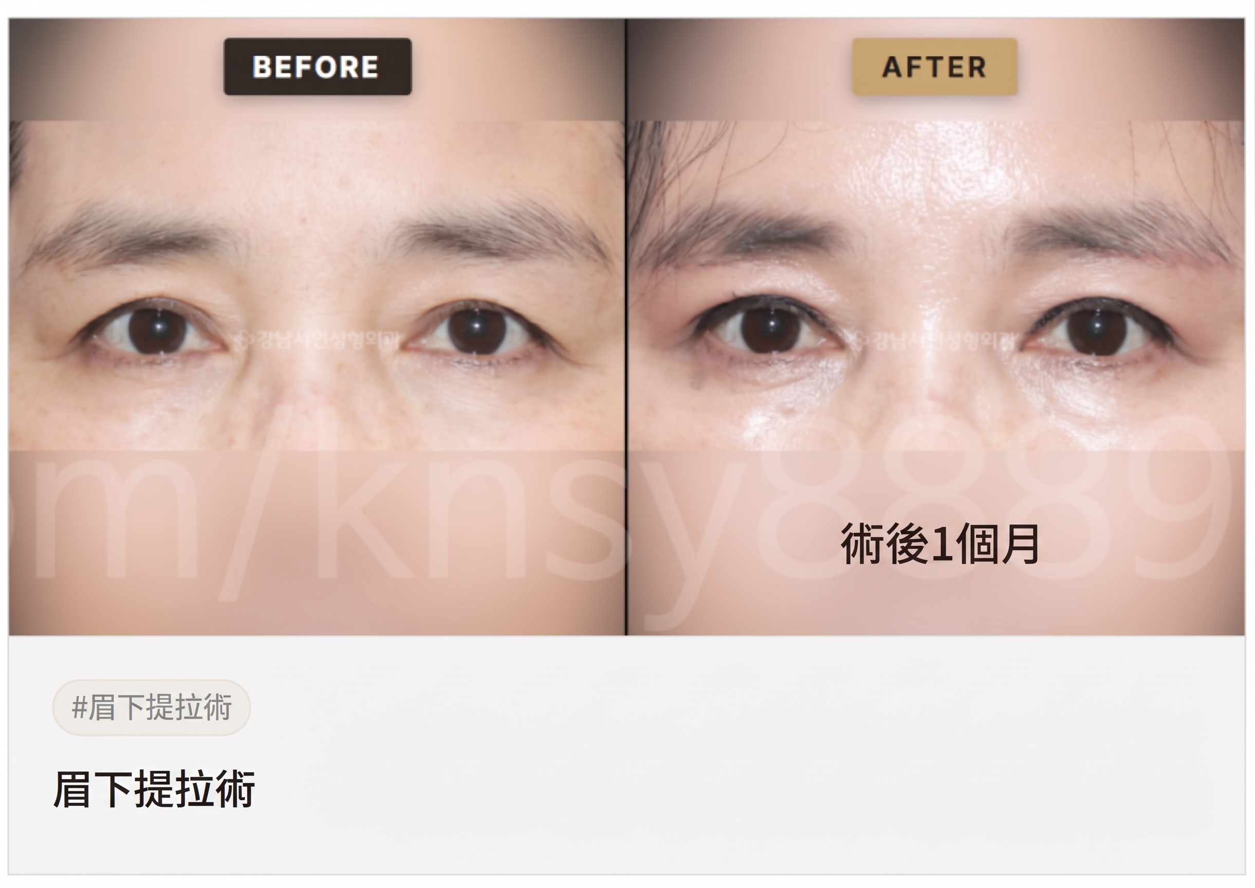 適合眉下拉提的情況,我符合條件嗎? 사진 3