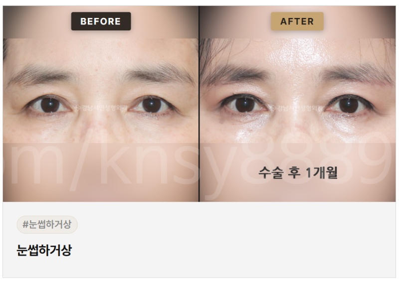 눈썹하거상 적합한 경우, 나는 해당될까요? 사진 3