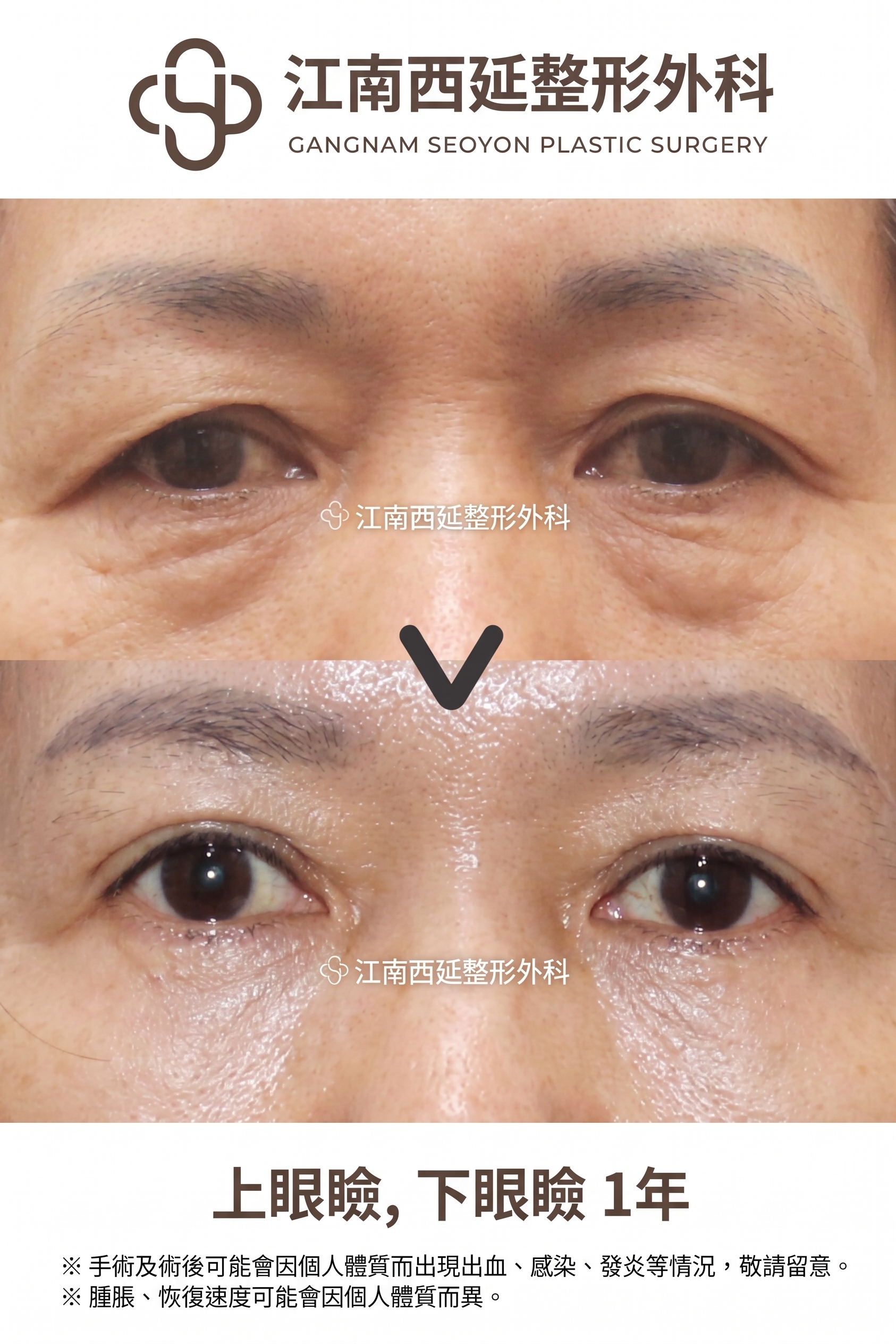 適合眉下拉提的情況,我符合條件嗎? 사진 4