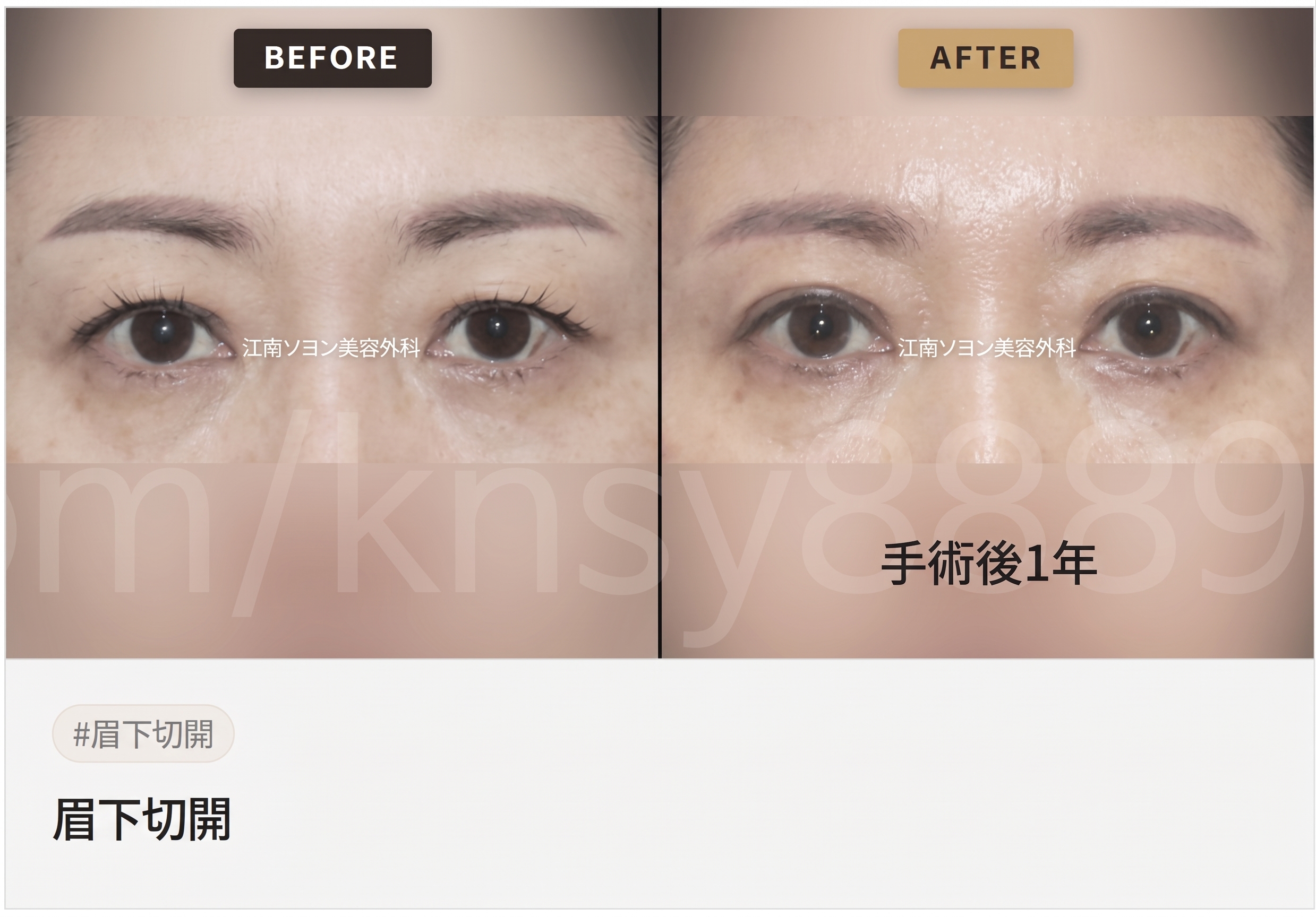 眉下切開（眉下リフト）が適しているケース、自分は当てはまる？ 사진 2