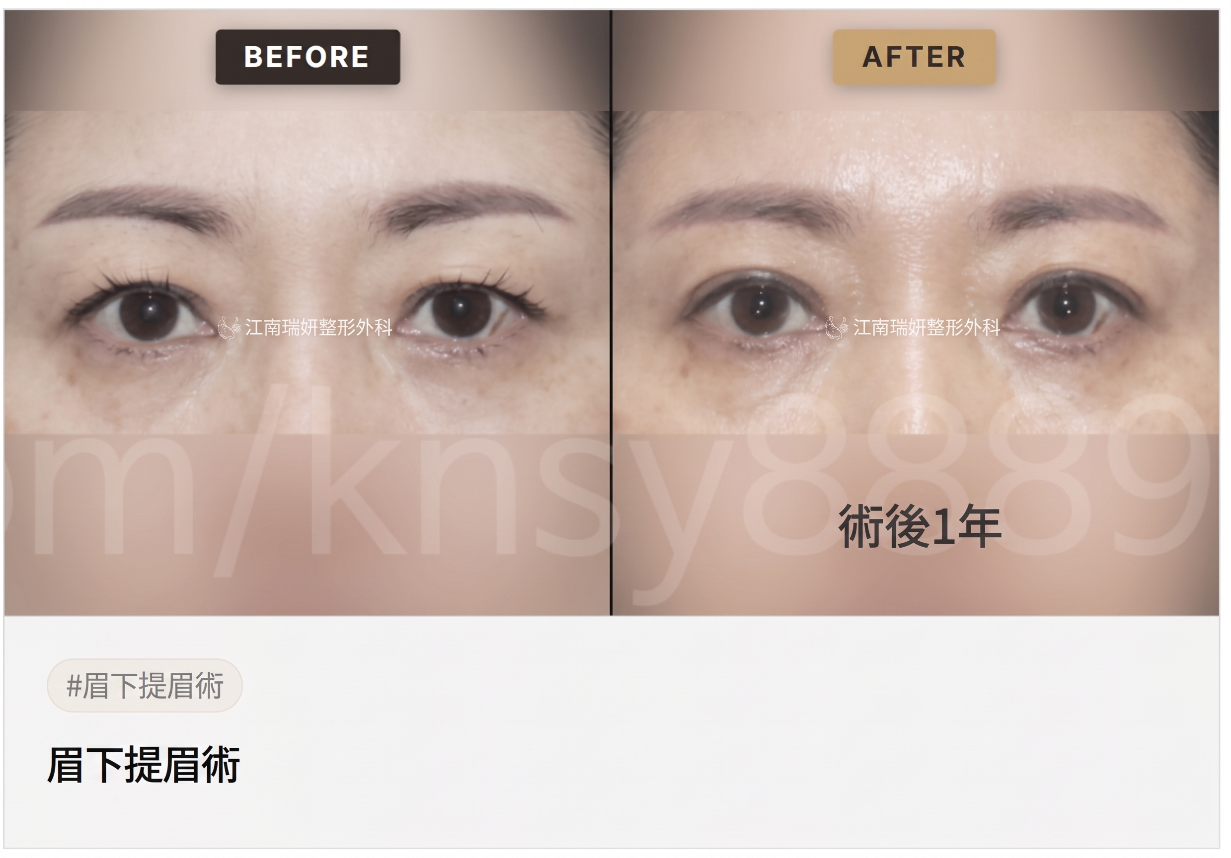 適合眉下拉提的情況,我符合條件嗎? 사진 2