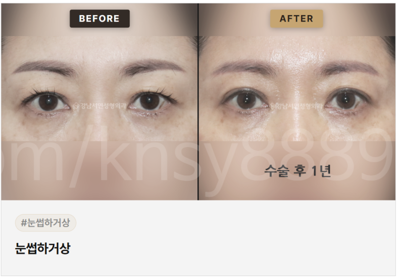 눈썹하거상 적합한 경우, 나는 해당될까요? 사진 2
