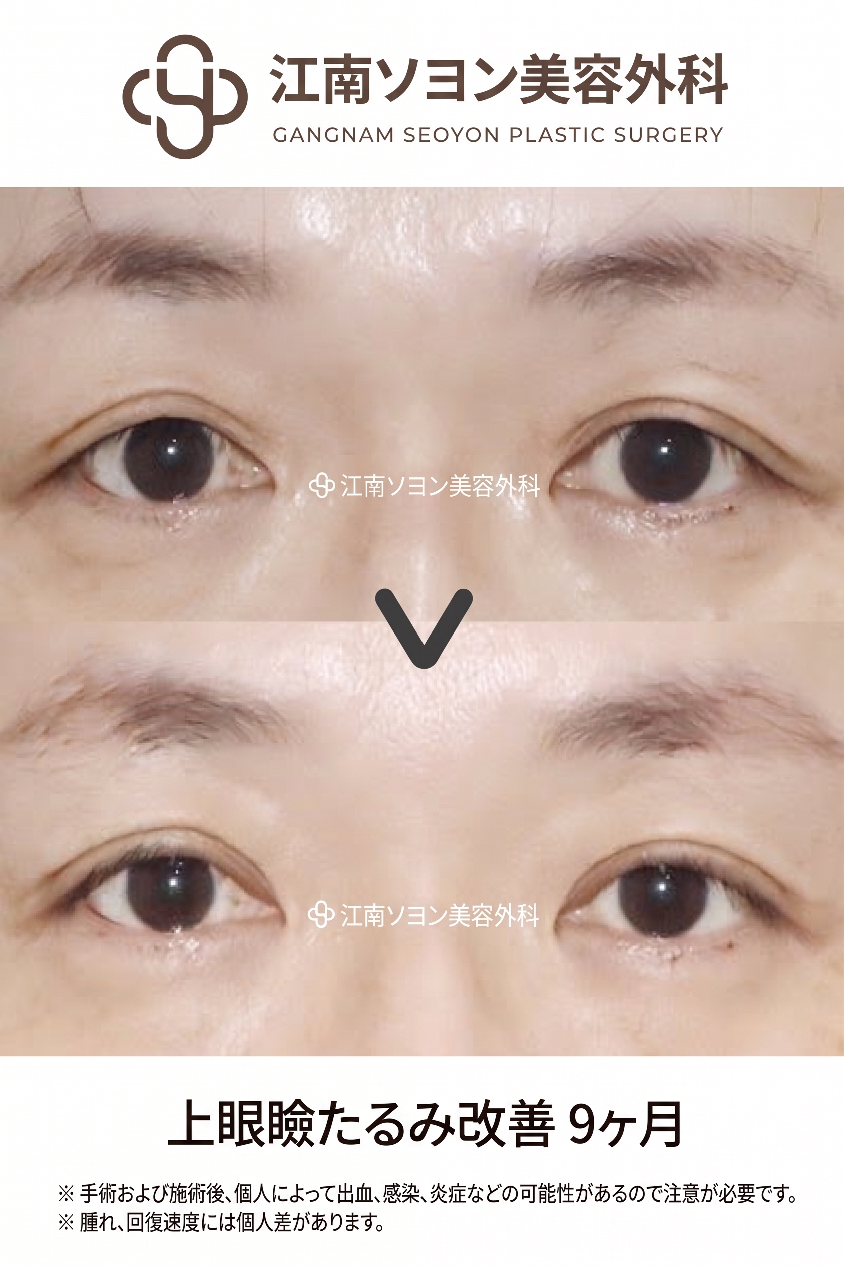 眉下切開（眉下リフト）が適しているケース、自分は当てはまる？ 사진 5