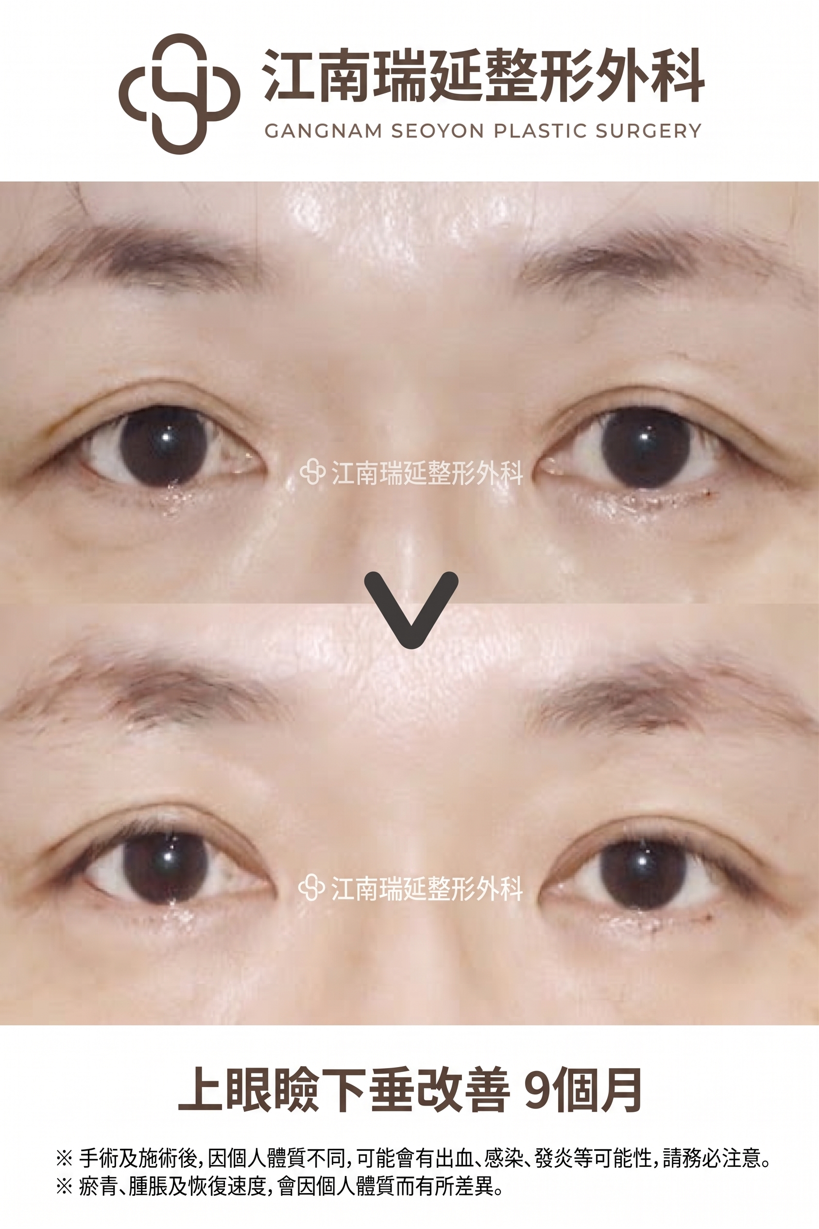 適合眉下拉提的情況,我符合條件嗎? 사진 5