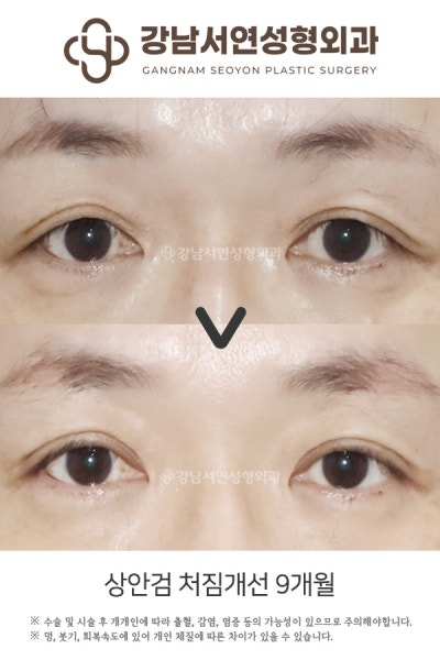 눈썹하거상 적합한 경우, 나는 해당될까요? 사진 5