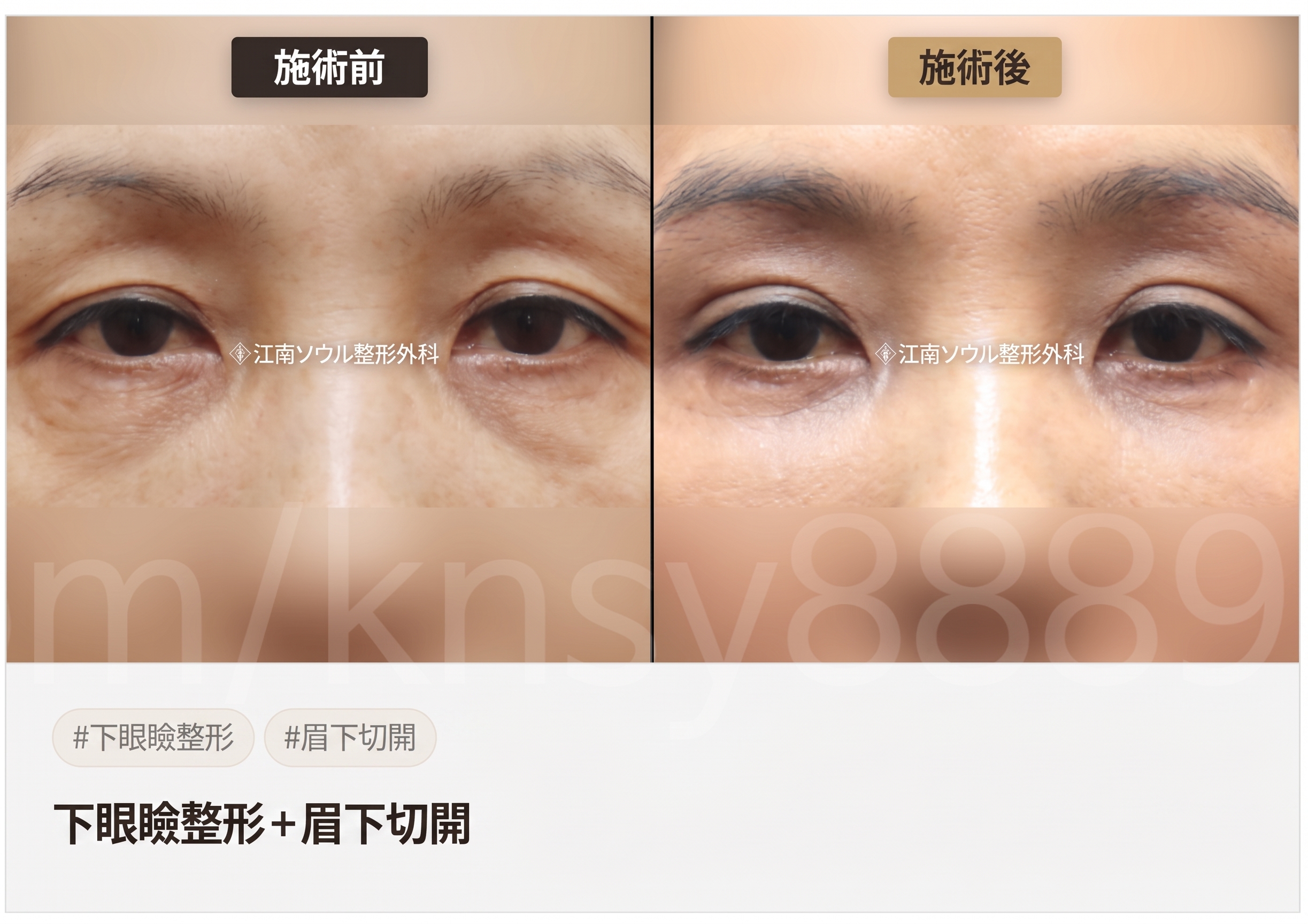 眉下切開（眉下リフト）が適しているケース、自分は当てはまる？ 사진 6