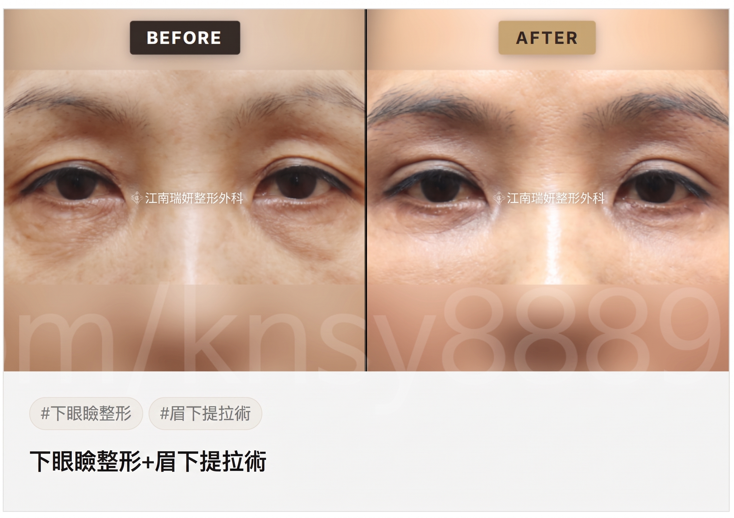 適合眉下拉提的情況,我符合條件嗎? 사진 6