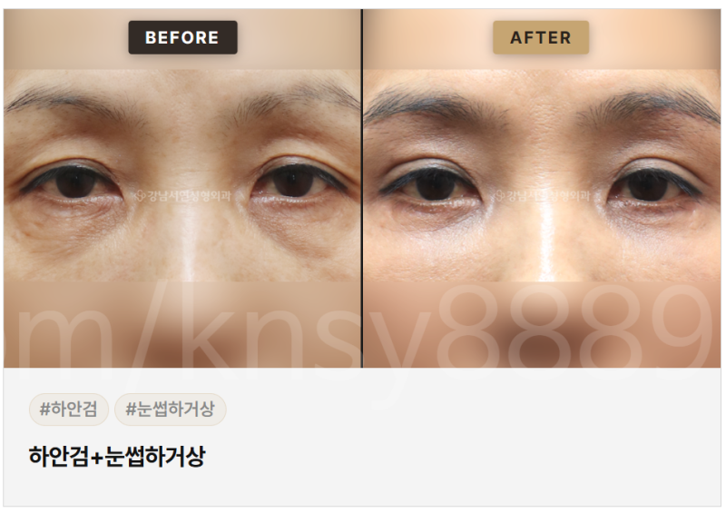 눈썹하거상 적합한 경우, 나는 해당될까요? 사진 6