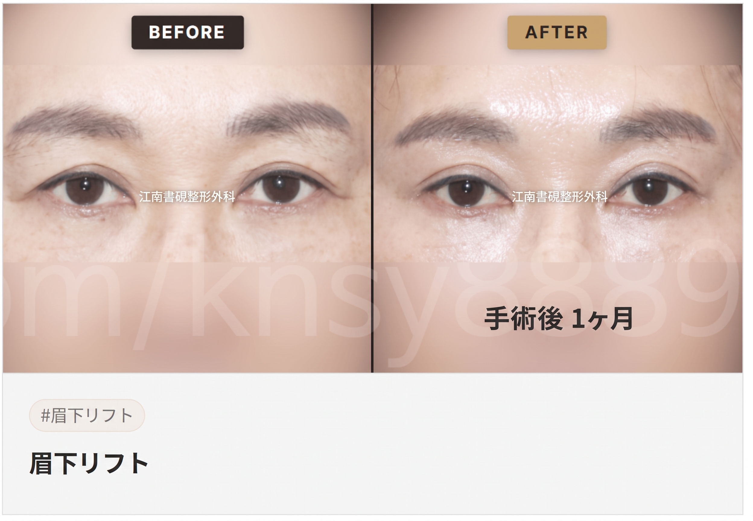 眉下切開（眉下リフト）が適しているケース、自分は当てはまる？