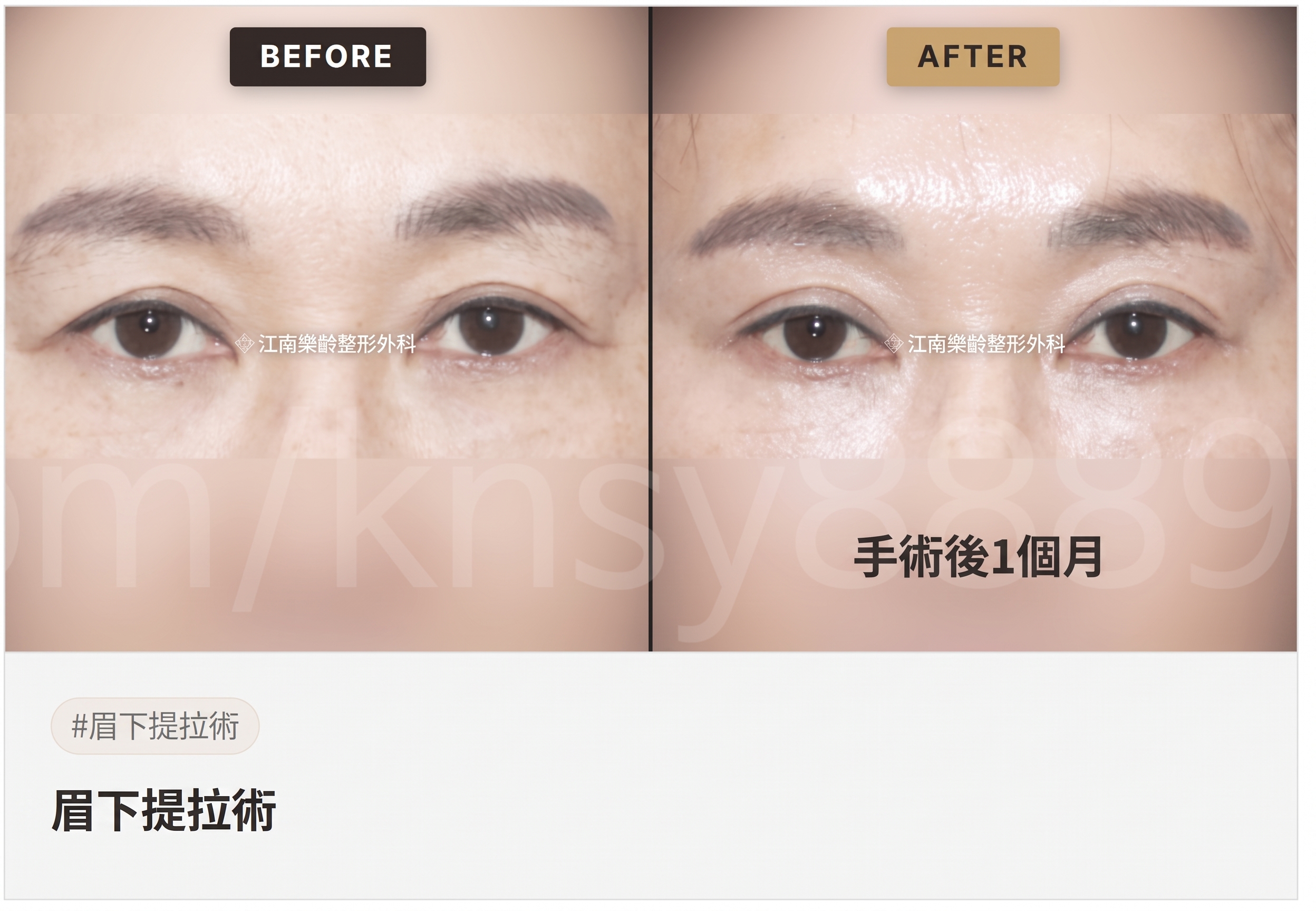 適合眉下拉提的情況,我符合條件嗎?