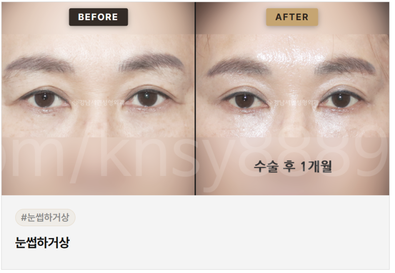 눈썹하거상 적합한 경우, 나는 해당될까요?