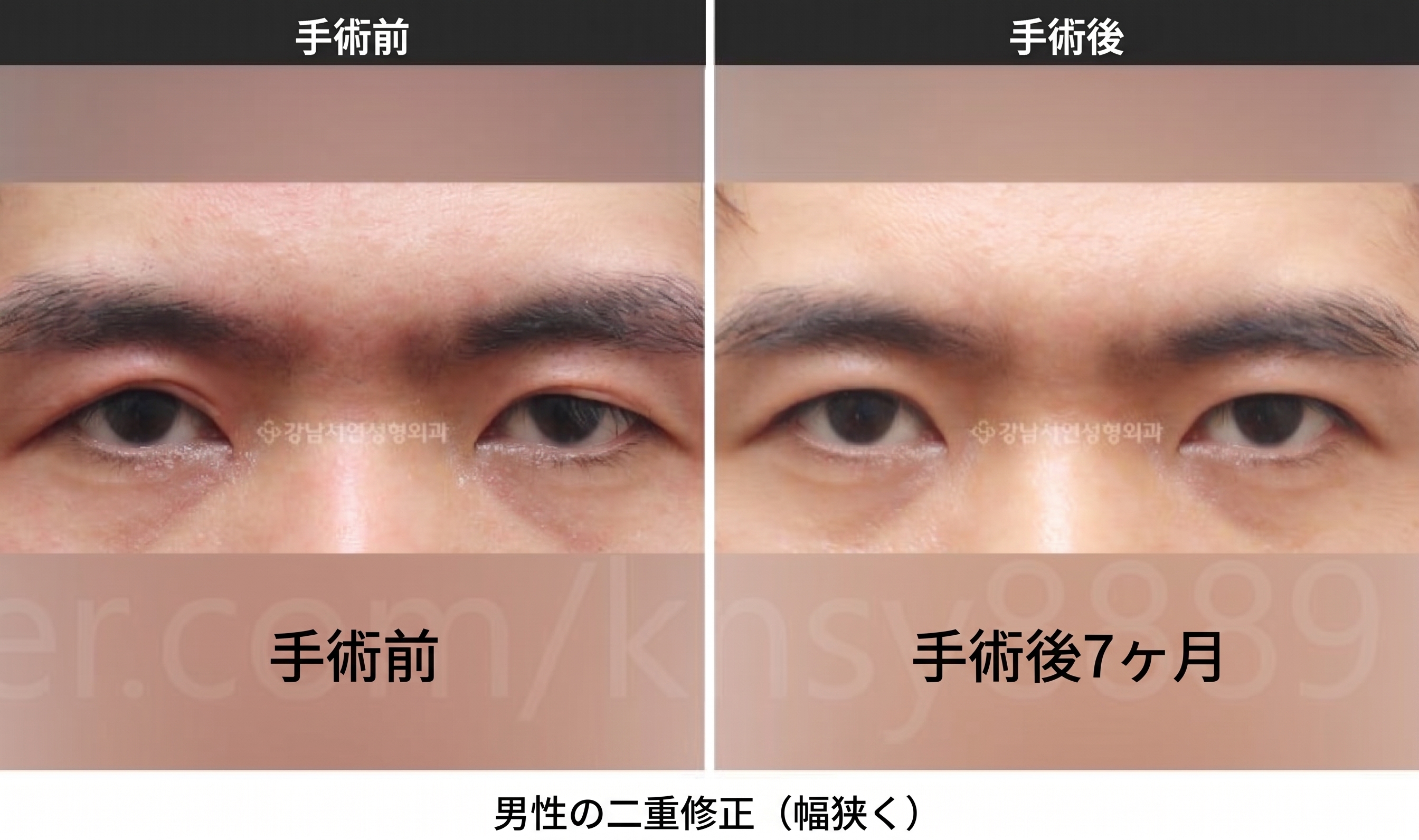 男性の二重幅狭小手術、世界初SCI論文が裏付ける理由 사진 2