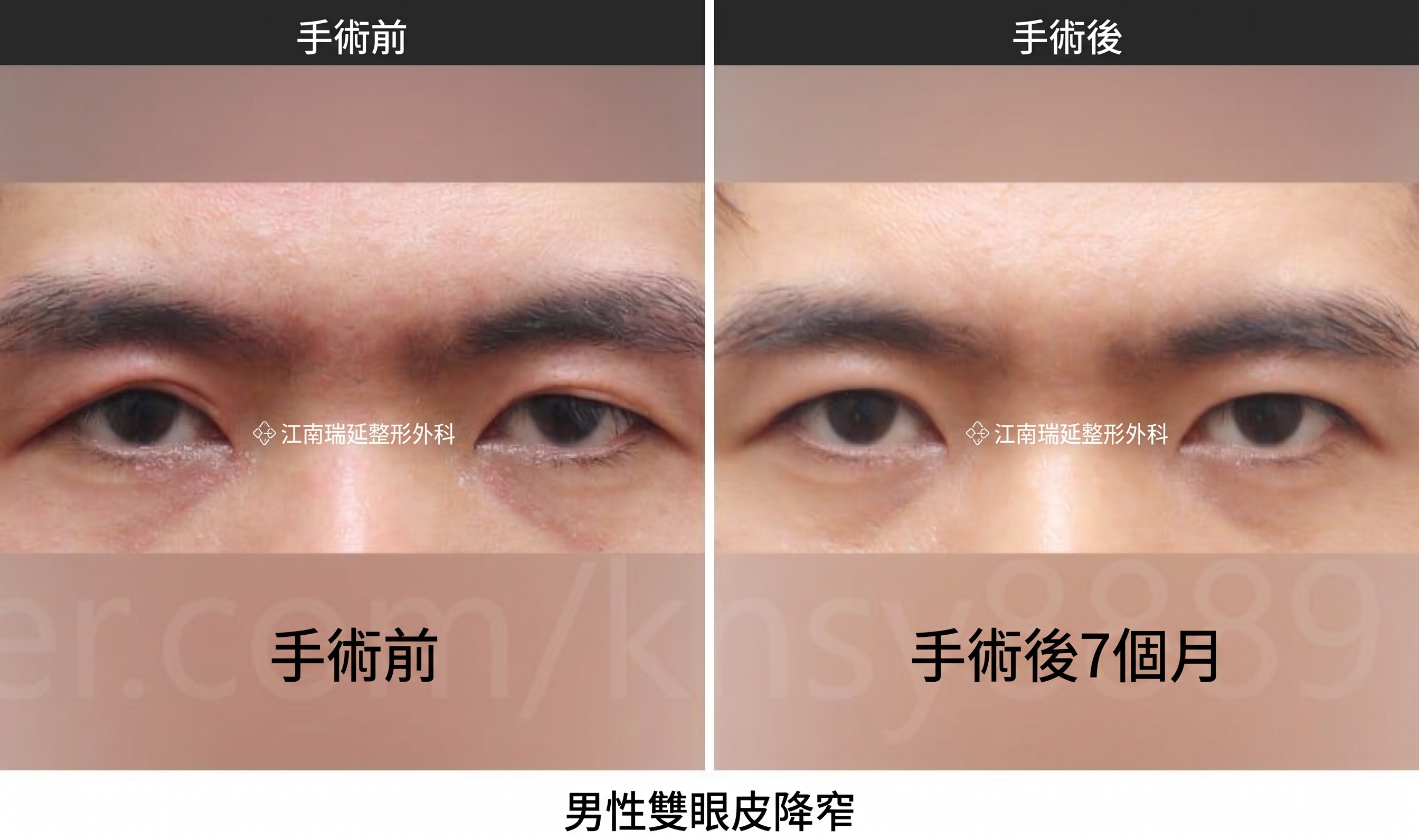 男性雙眼皮降窄手術，由全球首篇SCI國際論文佐證的專業實力 사진 2