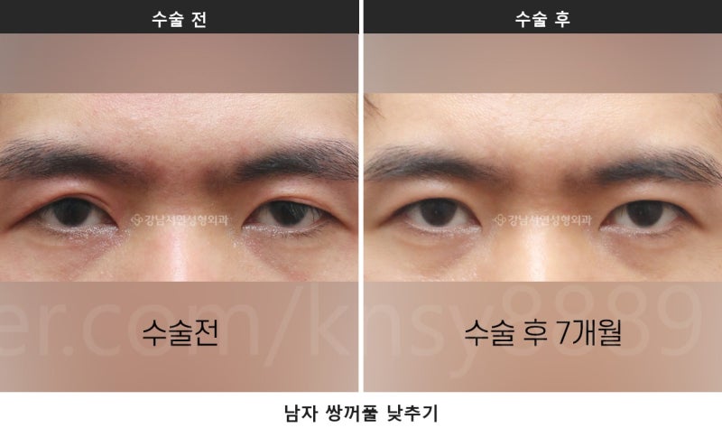 남자 쌍꺼풀 낮추기, 세계 최초 SCI 논문이 뒷받침하는 이유 사진 2