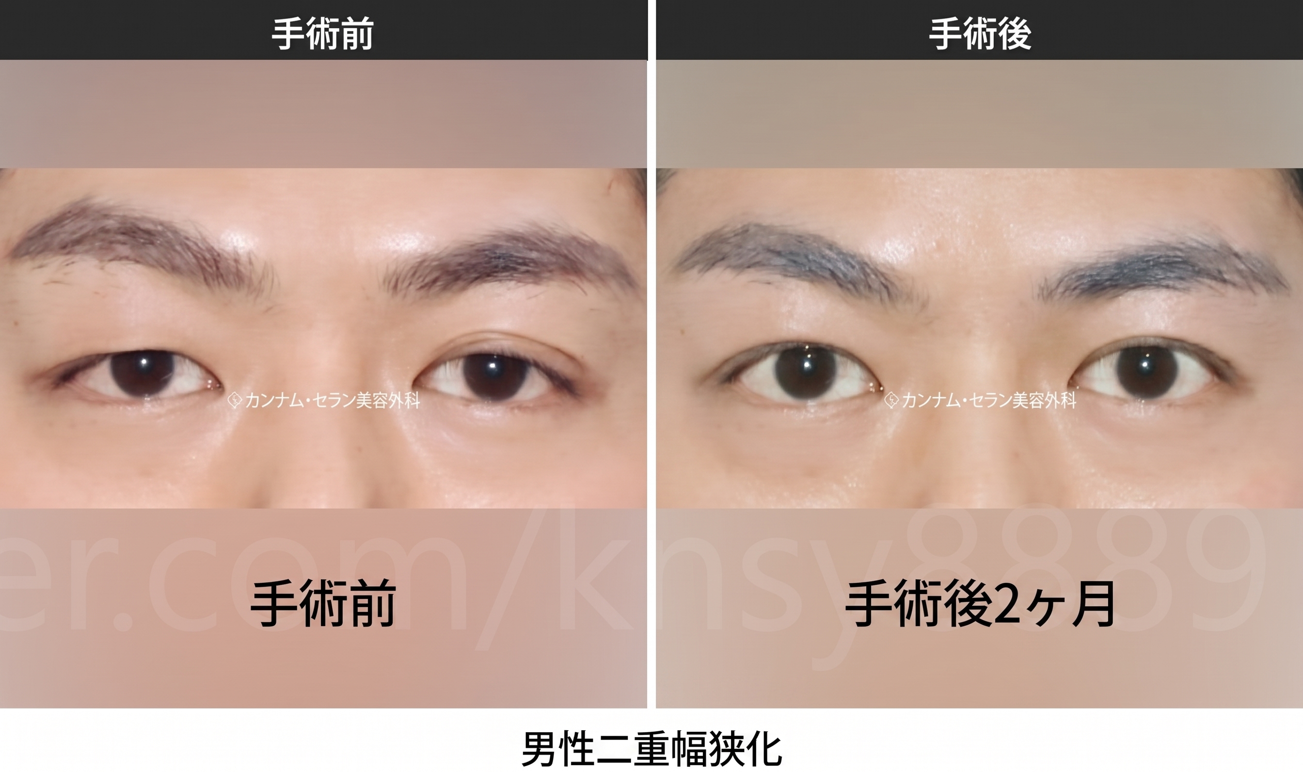 男性の二重幅狭小手術、世界初SCI論文が裏付ける理由 사진 8