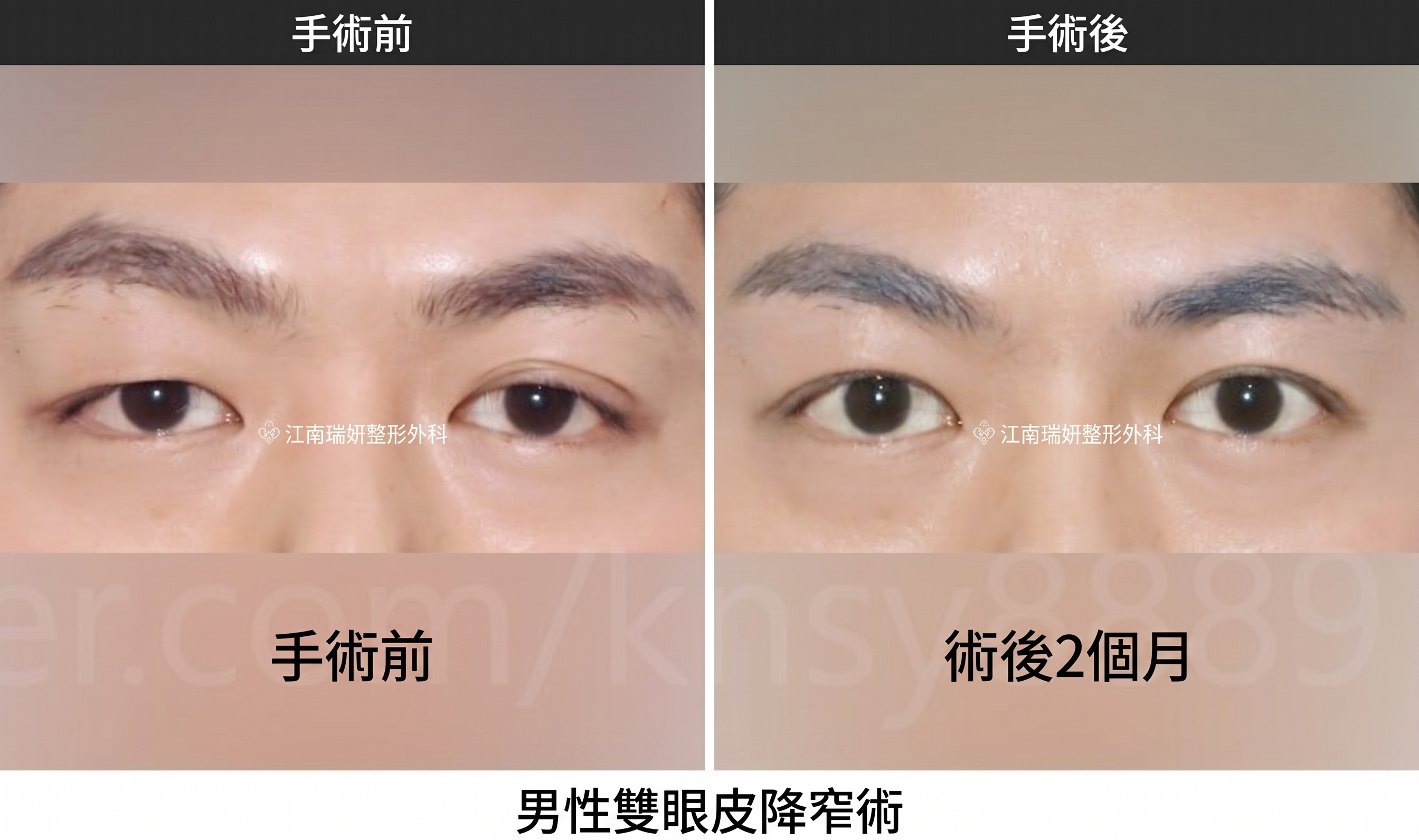 男性雙眼皮降窄手術，由全球首篇SCI國際論文佐證的專業實力 사진 8