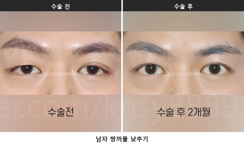 남자 쌍꺼풀 낮추기, 세계 최초 SCI 논문이 뒷받침하는 이유 사진 8