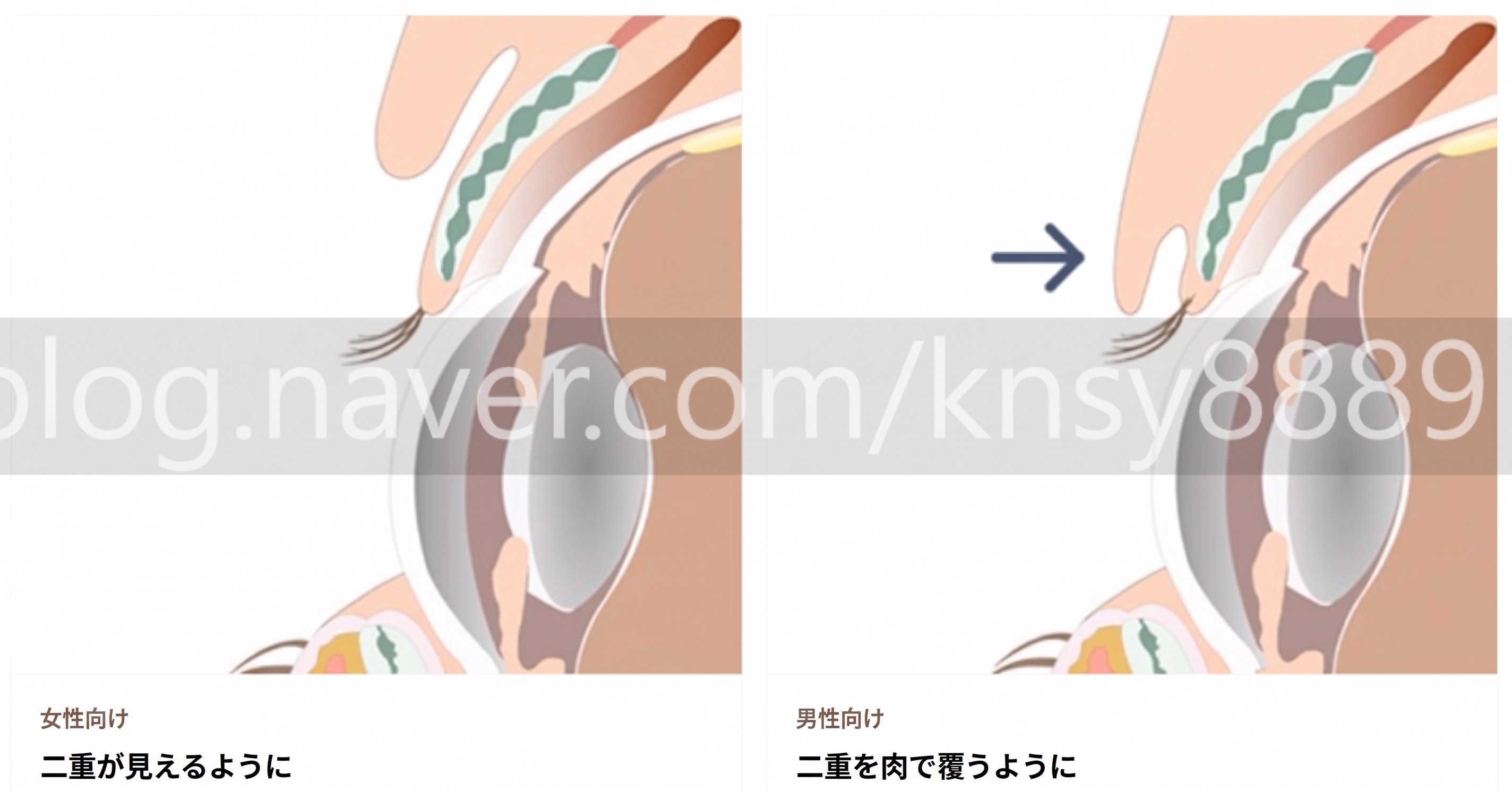 男性の二重幅狭小手術、世界初SCI論文が裏付ける理由 사진 9