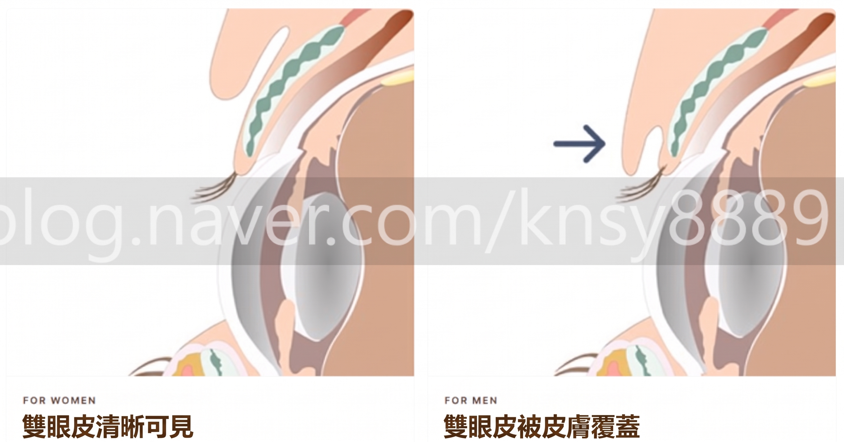 男性雙眼皮降窄手術，由全球首篇SCI國際論文佐證的專業實力 사진 9