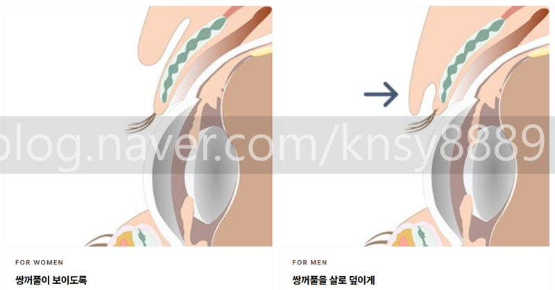 남자 쌍꺼풀 낮추기, 세계 최초 SCI 논문이 뒷받침하는 이유 사진 9