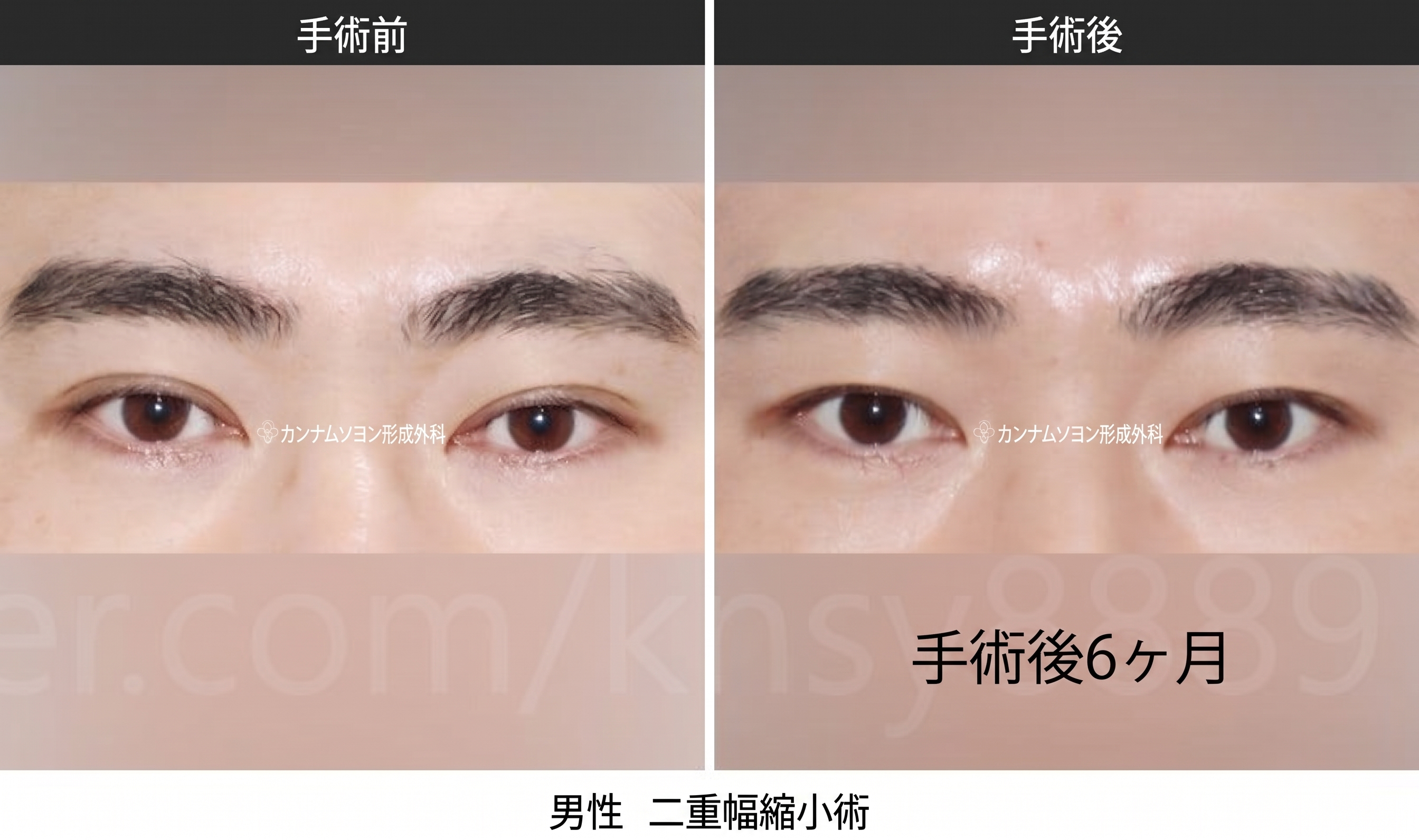 男性の二重幅狭小手術、世界初SCI論文が裏付ける理由 사진 7