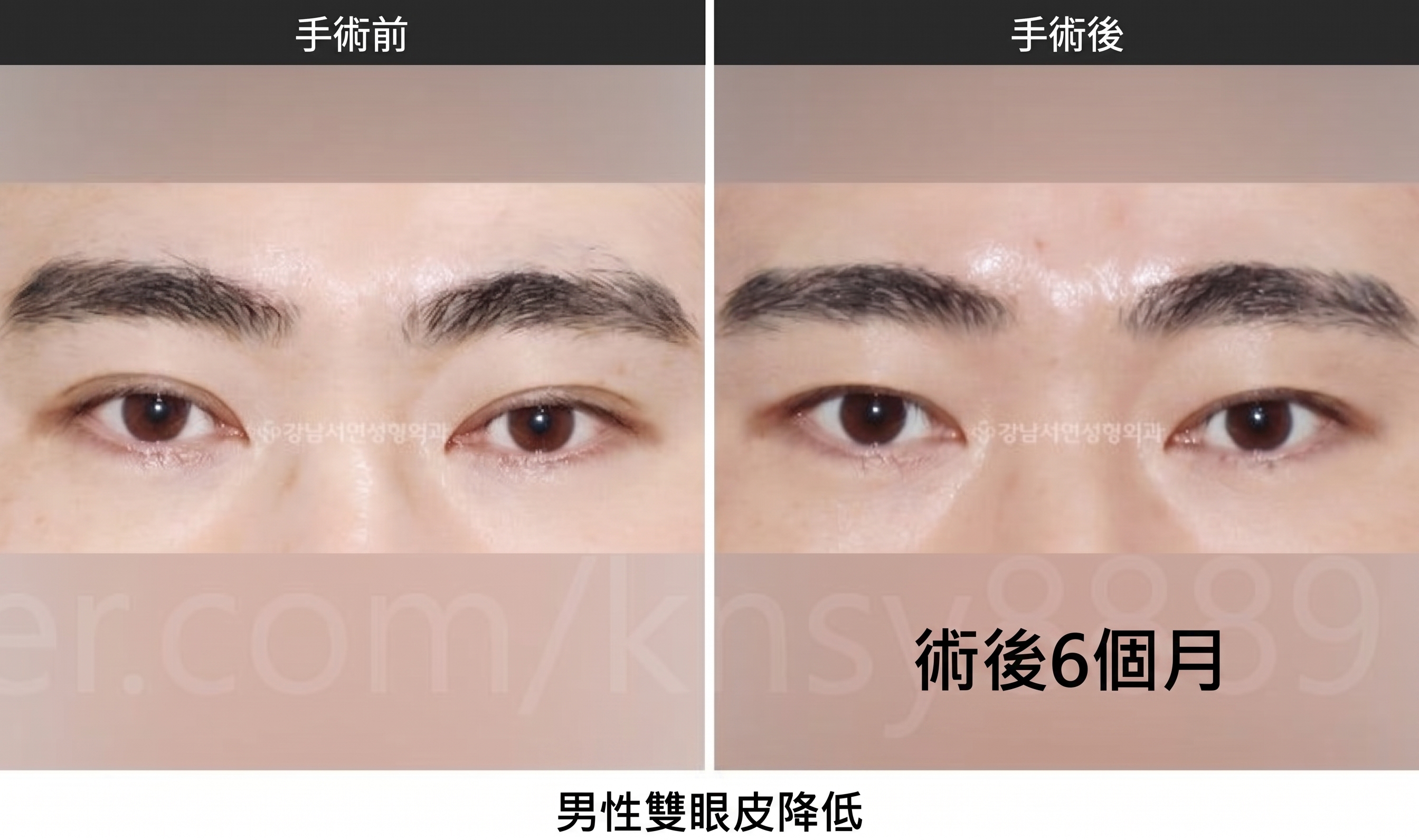 男性雙眼皮降窄手術，由全球首篇SCI國際論文佐證的專業實力 사진 7