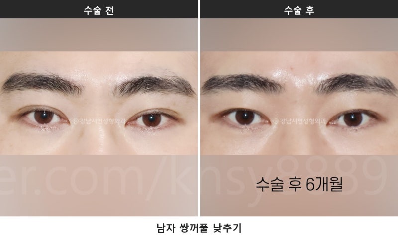 남자 쌍꺼풀 낮추기, 세계 최초 SCI 논문이 뒷받침하는 이유 사진 7