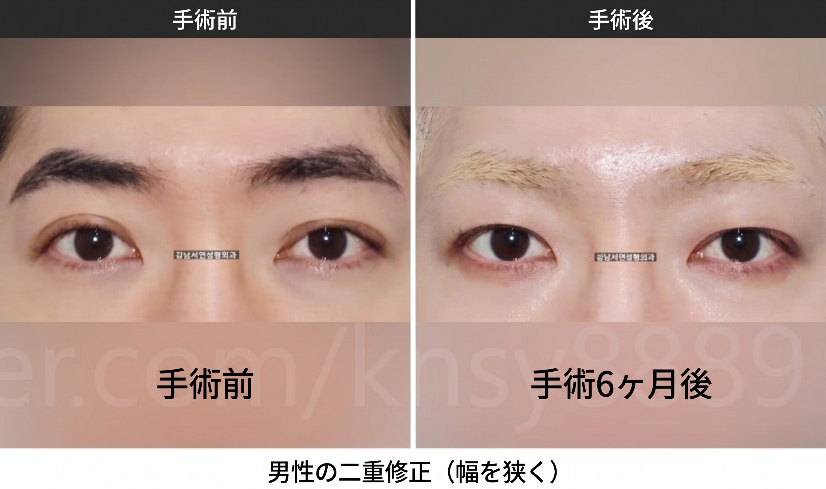 男性の二重幅狭小手術、世界初SCI論文が裏付ける理由