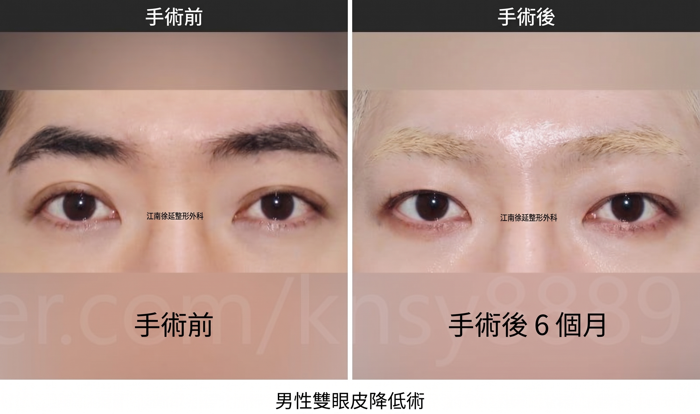 男性雙眼皮降窄手術，由全球首篇SCI國際論文佐證的專業實力