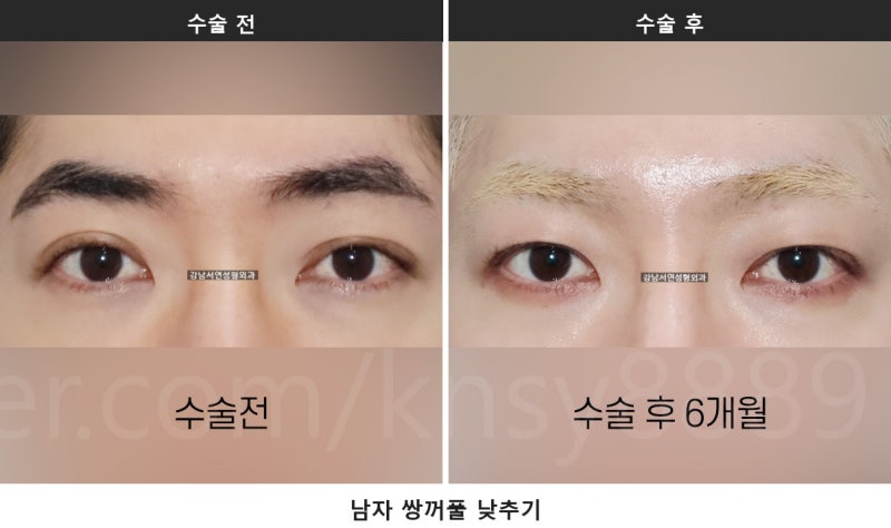 남자 쌍꺼풀 낮추기, 세계 최초 SCI 논문이 뒷받침하는 이유