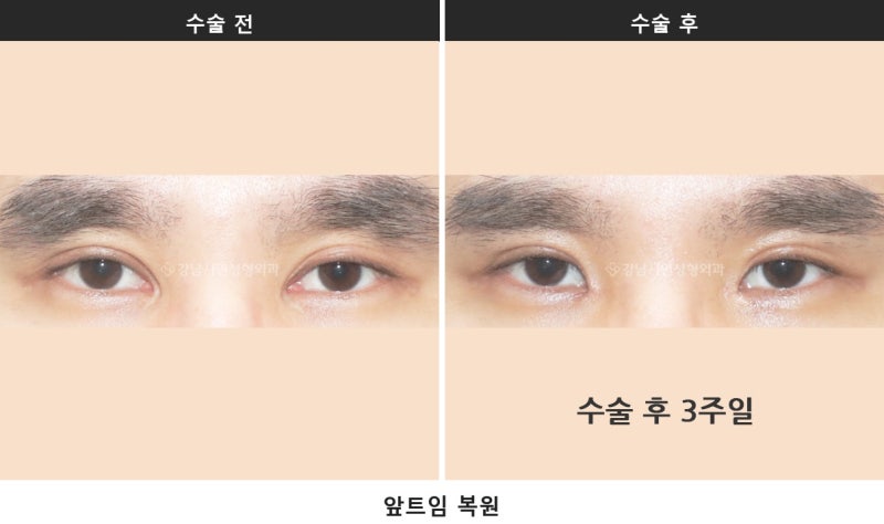 앞트임 복원, 회복기간은 얼마나 걸릴까 _ 앞트임 복원 전후사진