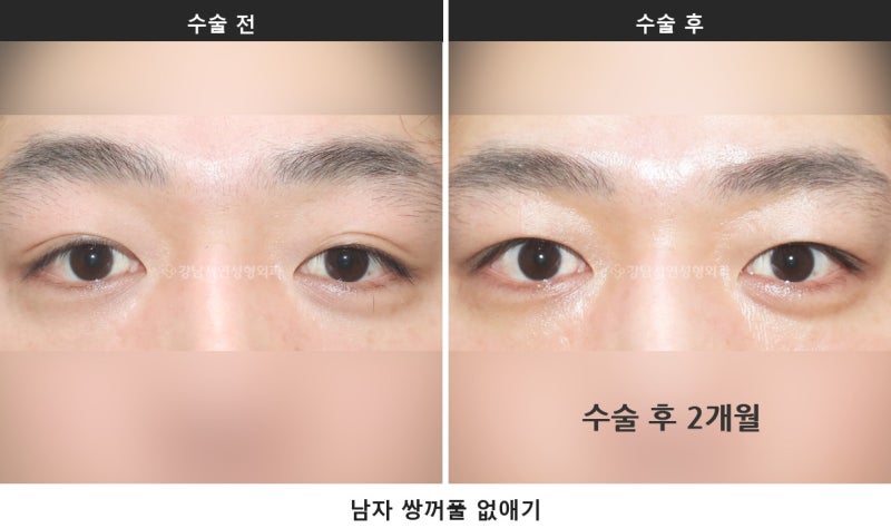 남자 쌍꺼풀 없애기, 살로 덮는 게 핵심입니다 사진 3