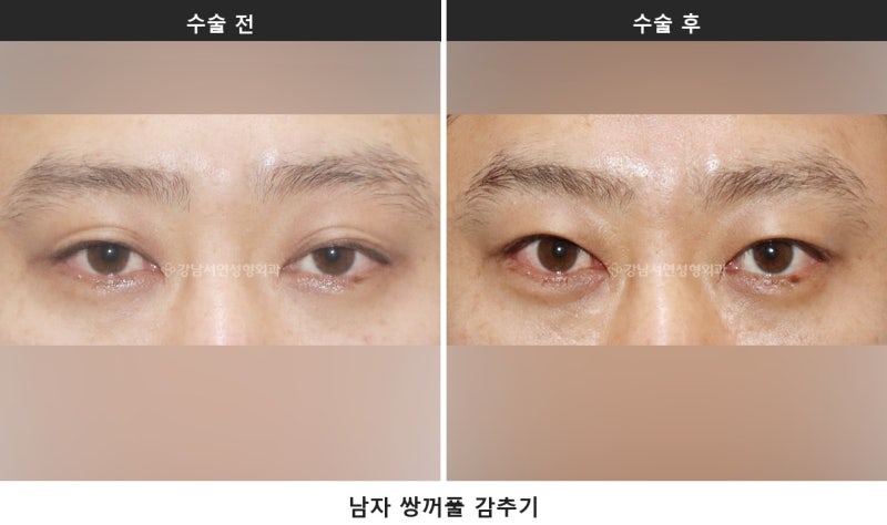 남자 쌍꺼풀 없애기, 살로 덮는 게 핵심입니다 사진 4