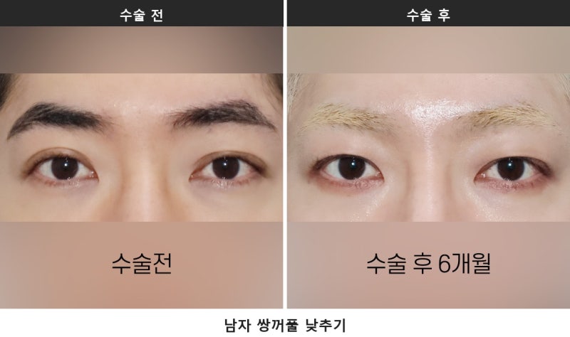 남자 쌍꺼풀 없애기, 살로 덮는 게 핵심입니다 사진 5