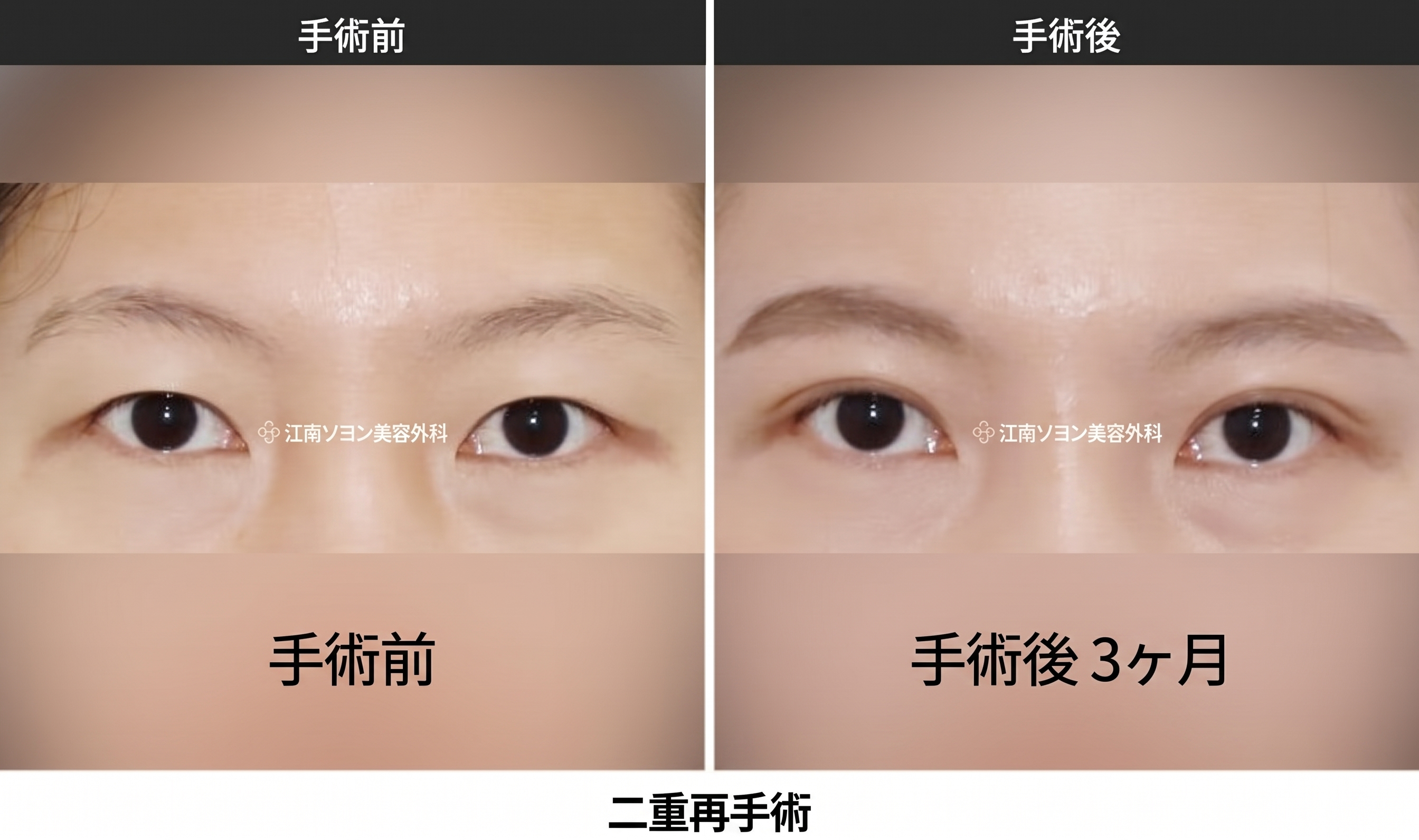 二重切開の抜糸時期と痛み・術後ケア|切開手術共通の回復プロセスを専門医が解説 사진 4