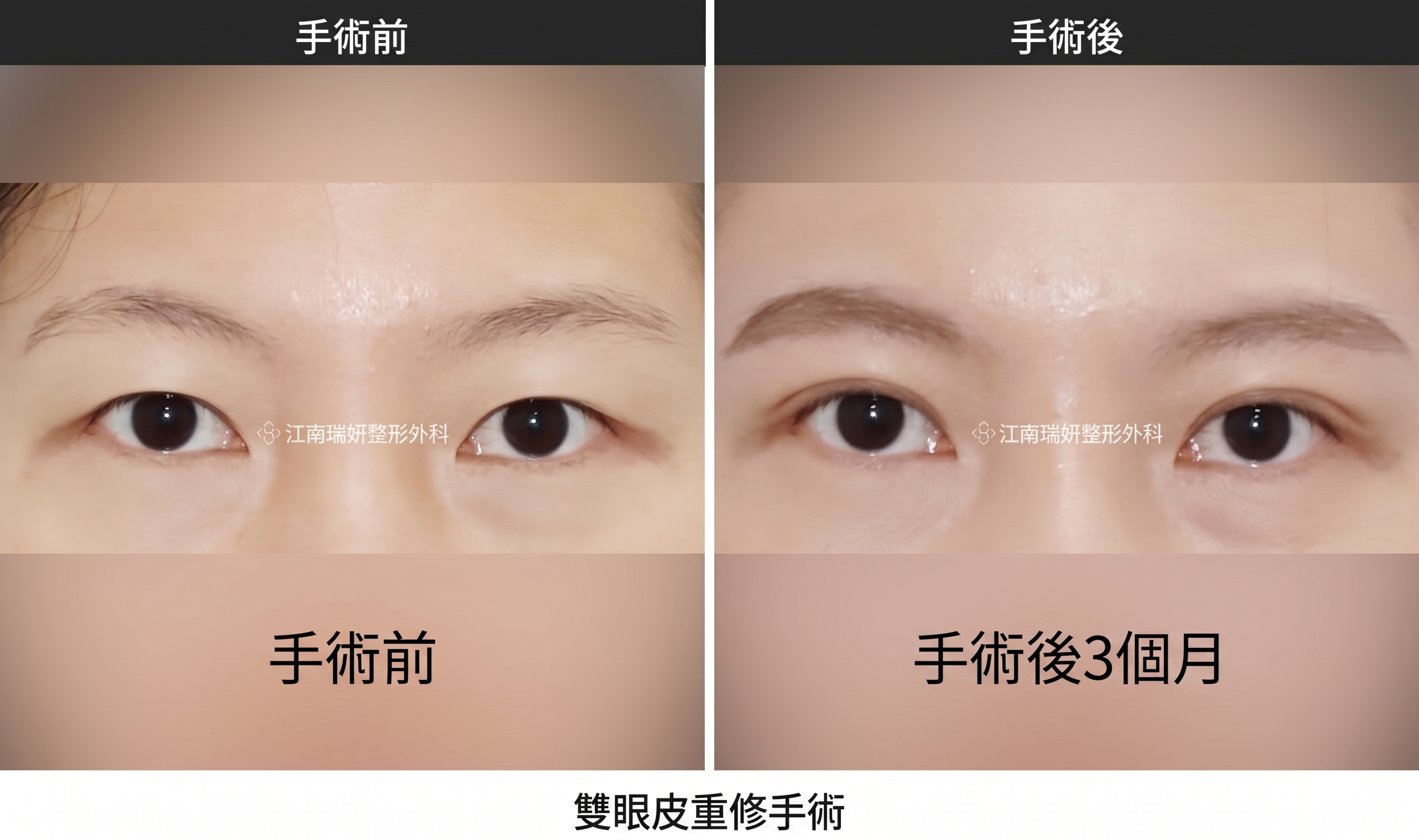 雙眼皮拆線，切開手術後必經的共同恢復階段 사진 4
