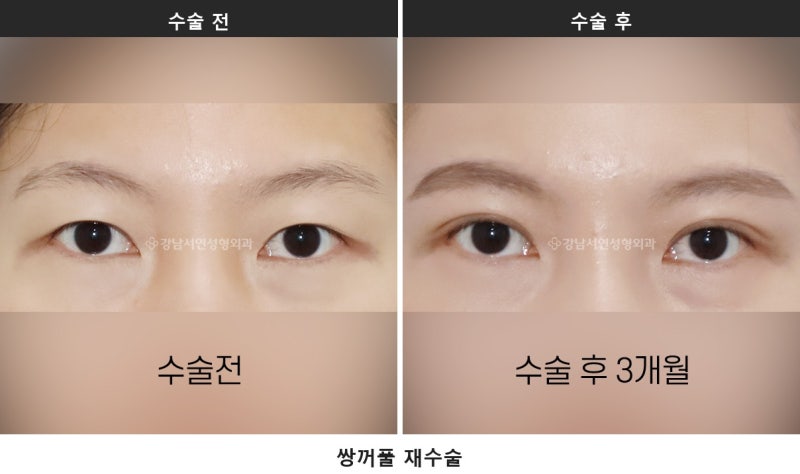 双眼皮拆线：切开手术后必经的共同恢复阶段 사진 4