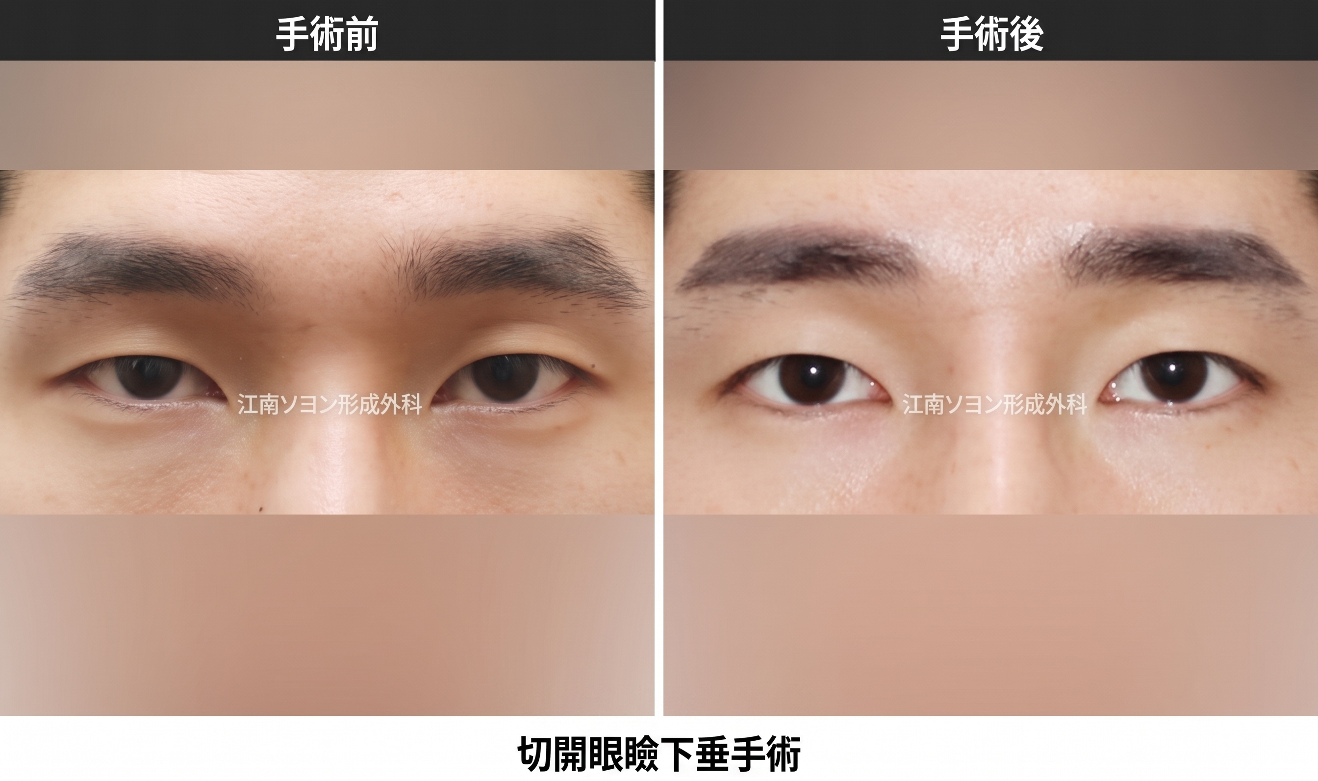 二重切開の抜糸時期と痛み・術後ケア|切開手術共通の回復プロセスを専門医が解説 사진 3