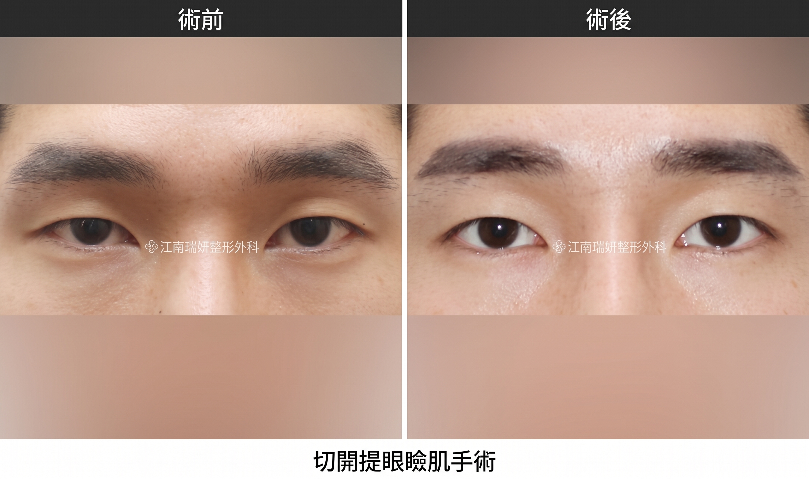 雙眼皮拆線，切開手術後必經的共同恢復階段 사진 3