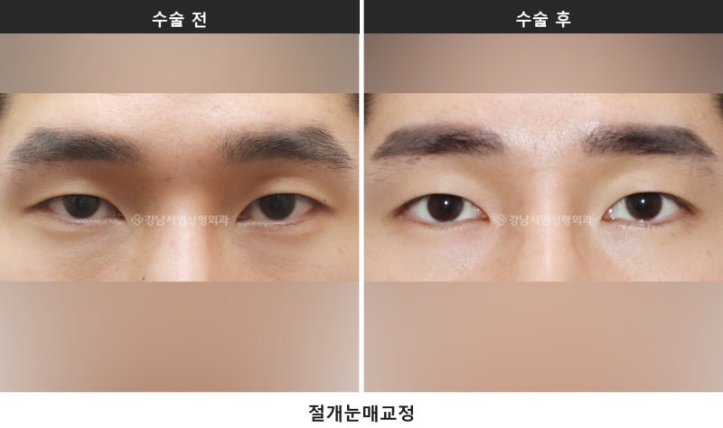 双眼皮拆线：切开手术后必经的共同恢复阶段 사진 3