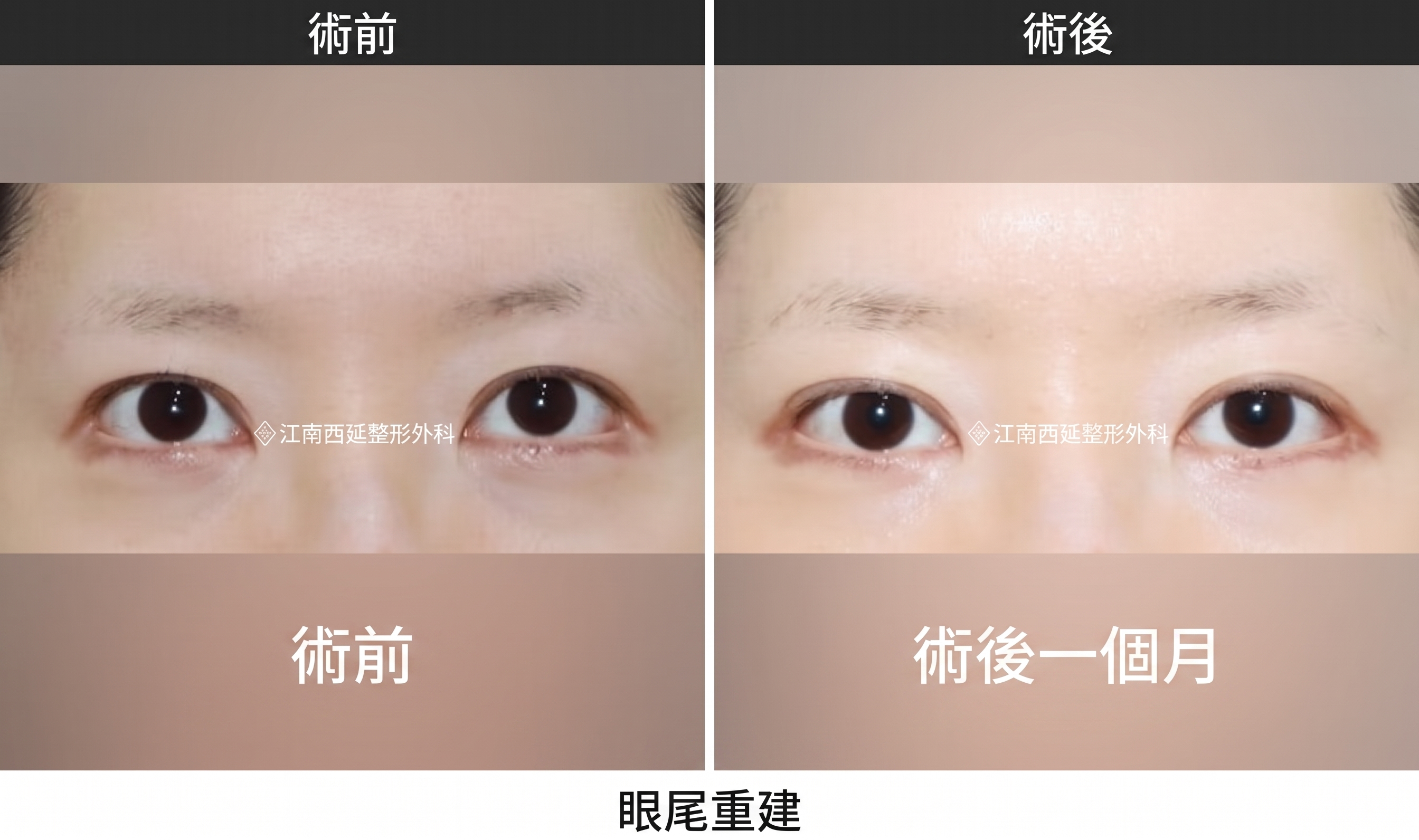 雙眼皮拆線，切開手術後必經的共同恢復階段 사진 2
