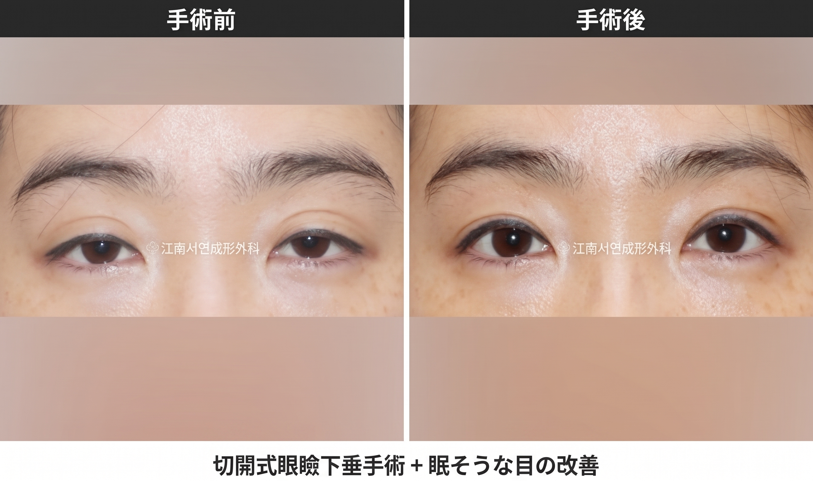 二重切開の抜糸時期と痛み・術後ケア|切開手術共通の回復プロセスを専門医が解説 사진 6